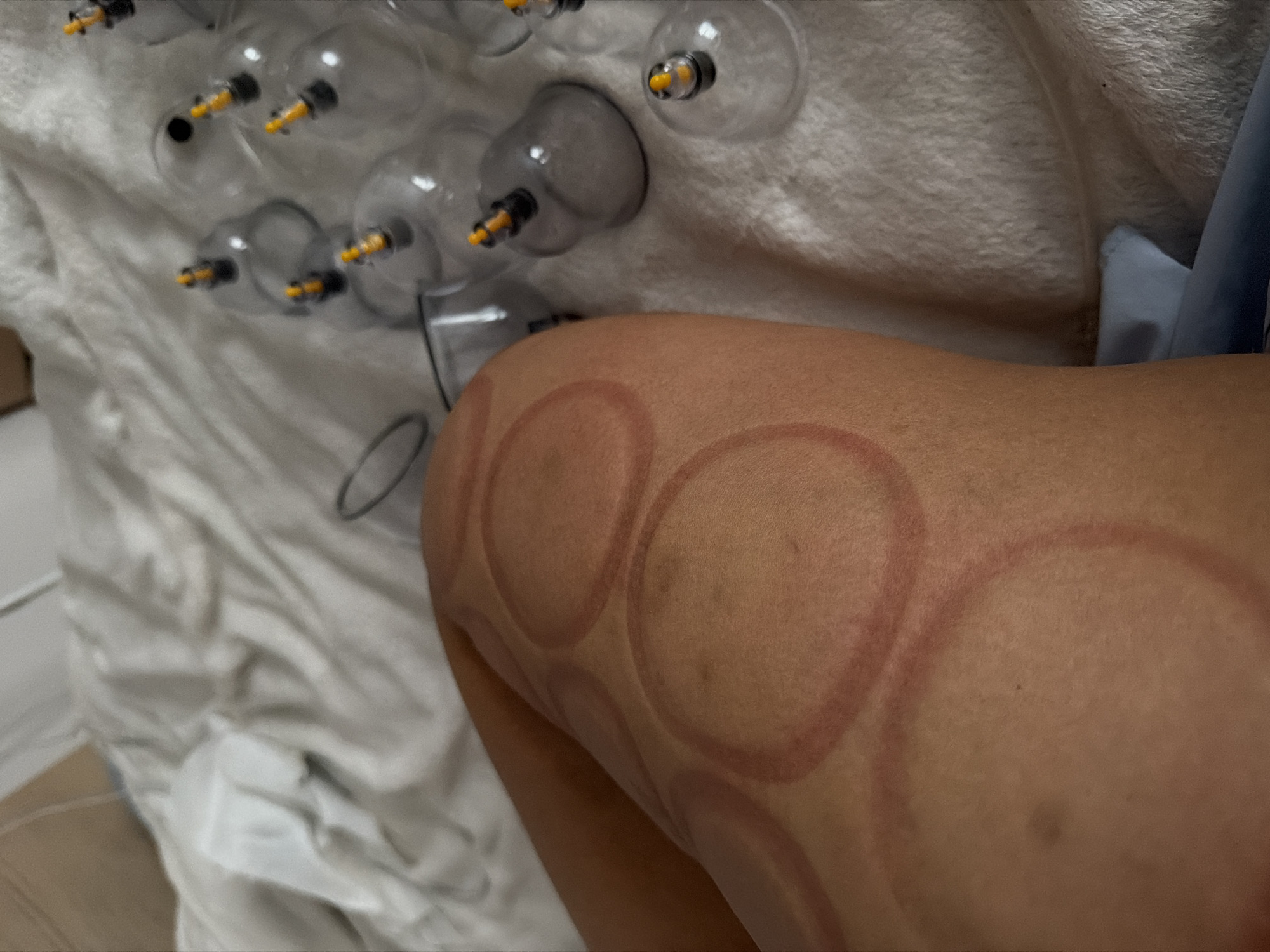 The image shows a human arm with prominent circular marks, indicating that cupping therapy has been performed. The marks are reddish-purple, suggesting suction was applied for a period. Several clear plastic cups, possibly used for the cupping treatment, are present in the background on a white cloth. The environment appears to be an indoor setting, possibly a treatment room or private residence. The specific location within an unknown city and region is not discernible from the provided image.