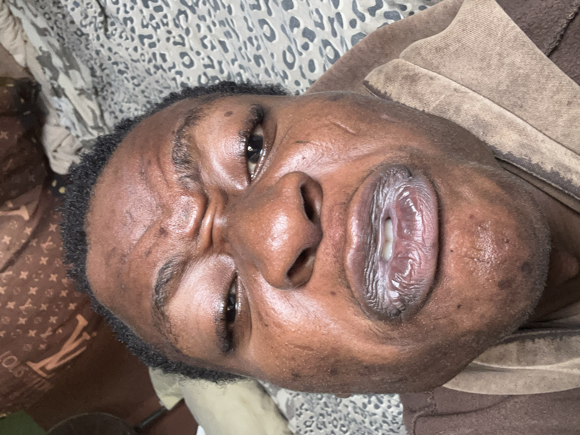 A close-up photograph shows a Black male's face. His expression suggests discomfort or pain, with furrowed brows and a strained mouth. His skin appears oily and exhibits minor imperfections. He is wearing a brown garment. A Louis Vuitton patterned object is in the background, as well as a leopard print bedding. The location is unknown.
