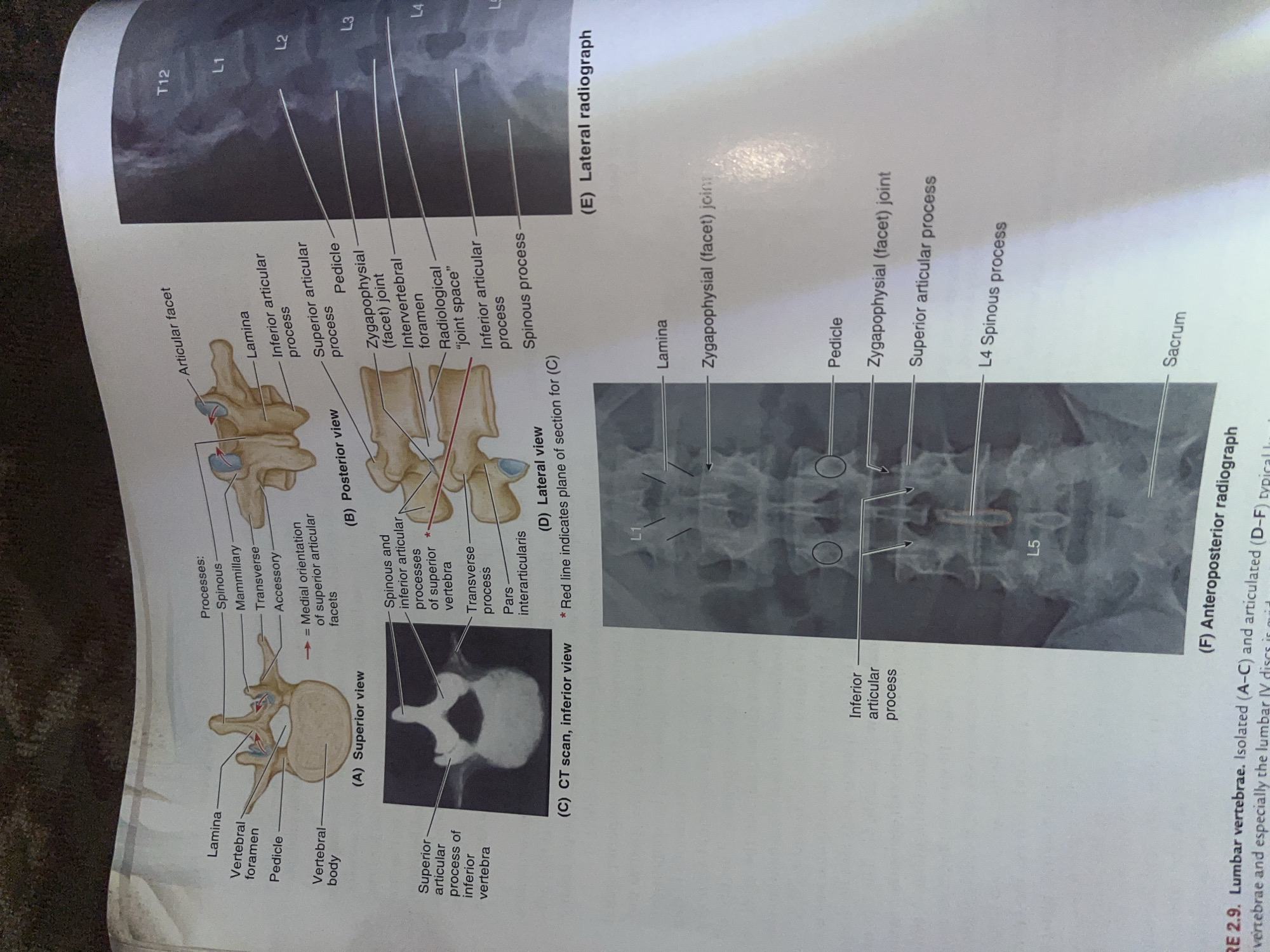The image displays a scientific illustration and radiographs of lumbar vertebrae. The illustration shows a superior view and a posterior view of a single vertebra, along with a CT scan and a lateral view of articulated vertebrae. Radiographs include a lateral and anteroposterior view of the lumbar spine. Labels point out anatomical features such as the lamina, pedicle, vertebral body, articular facets, and various processes. The radiographs show labeled vertebral levels from T12 to L5, and the sacrum. There is no information in the image that would allow for the description of a location in Jalingo, Nigeria.