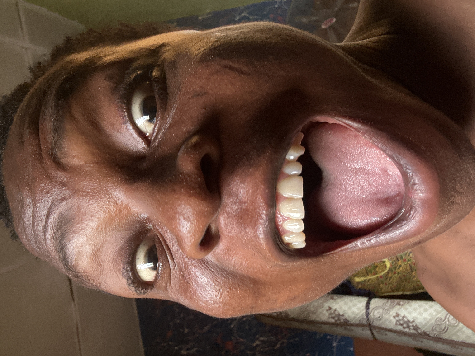 A close-up, portrait-style image, taken from a low and tilted angle, captures the face of a person with dark skin. The individual's head is rotated, filling most of the frame. Their mouth is opened extremely wide, revealing healthy, white teeth (incisors and canines) and a pink tongue. Both eyes are wide open and look directly towards the viewer, with distinct reflections indicating a light source. The skin on the face appears moist or oily, exhibiting fine texture and subtle folds, particularly around the eyes and mouth due to the exaggerated expression. Short, dark, curly hair is visible around the forehead and temples. The background is blurred and indistinct, suggesting an indoor setting with hints of patterned surfaces and muted colors below the chin. The person's expression conveys a strong emotion, possibly surprise, shock, or a loud vocalization like a yell or scream. No visible text is present.