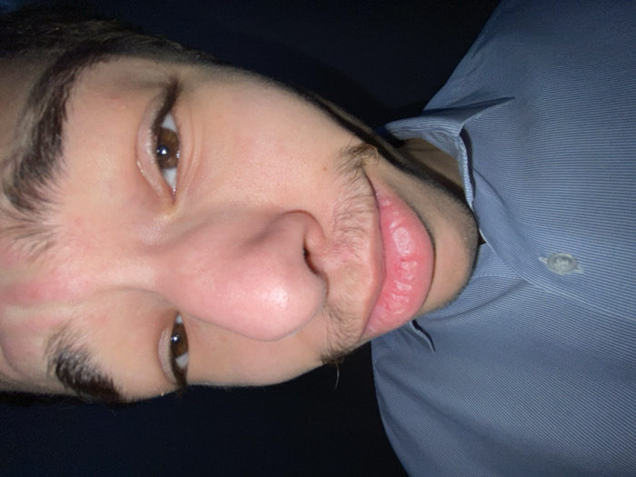 The scene, set in Strasbourg, France, presents a close-up, vertically oriented portrait of a single individual, identified as a young adult male, whose head is rotated approximately 90 degrees counter-clockwise relative to the camera's upright axis. The subject's direct gaze is towards the camera. Notable features include dark brown eyes, well-defined dark eyebrows, a prominent nose, and full lips. Fine, dark facial hair is visible above the upper lip and along the chin/jawline. The lower lip displays several raised, off-white lesions consistent with oral herpes or severe chapping. A mild erythra is present on the viewer's left cheek. The individual wears a light blue, collared, vertically striped button-up shirt, partially visible on the right side of the frame. The background is uniformly dark and devoid of distinguishing features, indicating an interior or low-light setting.