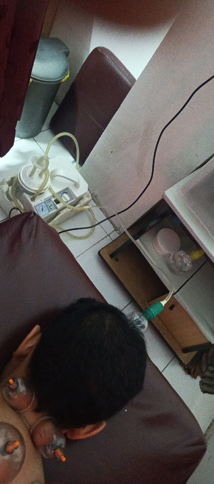 The image shows an overhead view of a person receiving cupping therapy on their back. Several glass cups with orange valves are attached to the skin. A suction device with tubes is connected to one of the cups. The person is lying on a brown surface, possibly a massage table. In the background, there is a grey trash can, a dark brown cushion, and a white wall with some electrical cords. The flooring appears to be tiled. The scene is indoors and seems to be in a treatment room. The location is stated to be Sukaresmi, Indonesia.