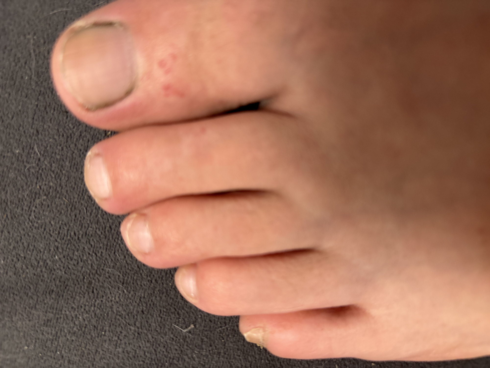 A close-up photograph shows the top of a human foot. The foot has five toes, with the toenails of the big toe and pinky toe showing some dirt or debris. There are some small red spots or marks visible on the skin near the base of the big toe. The foot appears to be resting on a dark, textured surface that could be fabric.
There is no information to suggest this image was taken in Tolyatti, Russia. The photograph does not provide any context or location details.