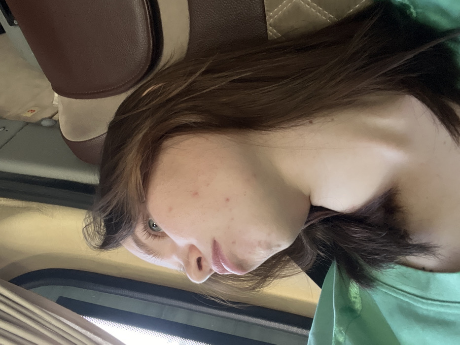 In Lipovka, Russia, an image captures a young individual in profile, situated inside a vehicle, looking out a window to the left. The individual has medium-brown hair, blue eyes, and light skin displaying multiple blemishes on the cheek and jawline. A light green t-shirt is visible on their left shoulder. To the right and behind the individual, a dark brown upholstered seat with beige-tan accents and a quilted pattern is present, suggesting a bus or train interior. Bright ambient light originates from the exterior, through the window, illuminating the scene. The individual's expression appears observant or contemplative as they look out.