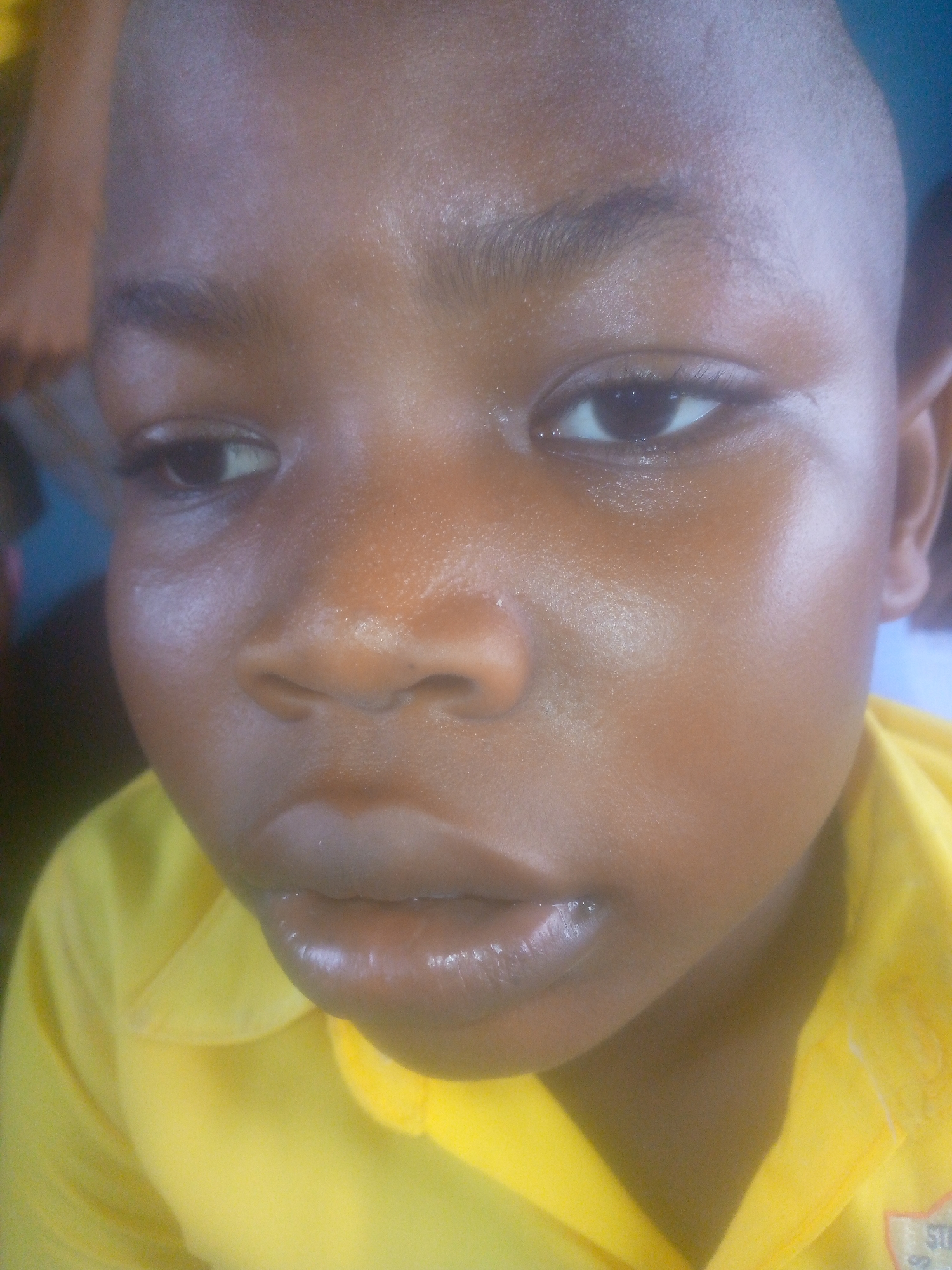 Close-up of a young Black male child wearing a yellow collared shirt, cropped above the chest. The child has close-cropped hair, brown eyes, and a slightly swollen left cheek. The location is unknown.
