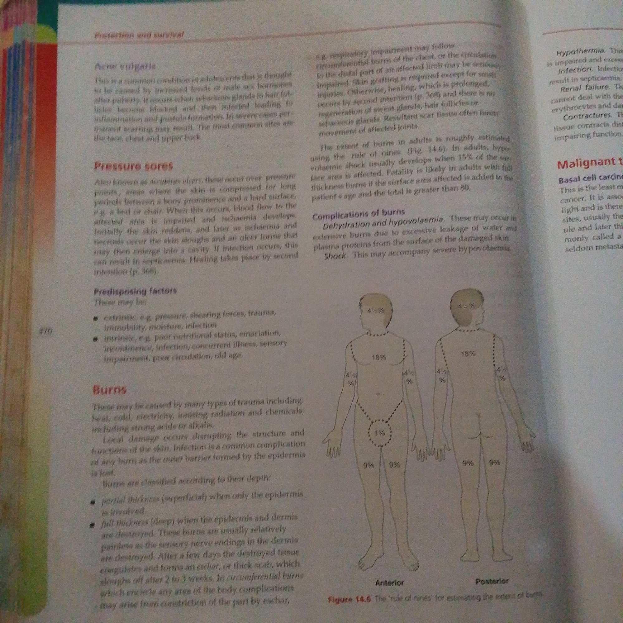 The image displays a page from a medical textbook discussing skin conditions and burns. The text on the left side details "Acne vulgaris" and "Pressure sores," along with "Predisposing factors" and a section on "Burns." The "Burns" section elaborates on causes, local damage, and classification by depth, differentiating between partial and full thickness burns. An illustration labeled "Figure 14.6 The 'rule of nines' for estimating the extent of burns" is shown on the right. This diagram depicts the anterior and posterior views of a human body, with percentages indicating the distribution of body surface area for burn assessment. The text below the illustration provides a caption for the figure. The overall environment is that of an indoor setting, likely a study or library, with the book open to this page. There is no information present in the image that relates to Jalingo, Nigeria, or any specific city.