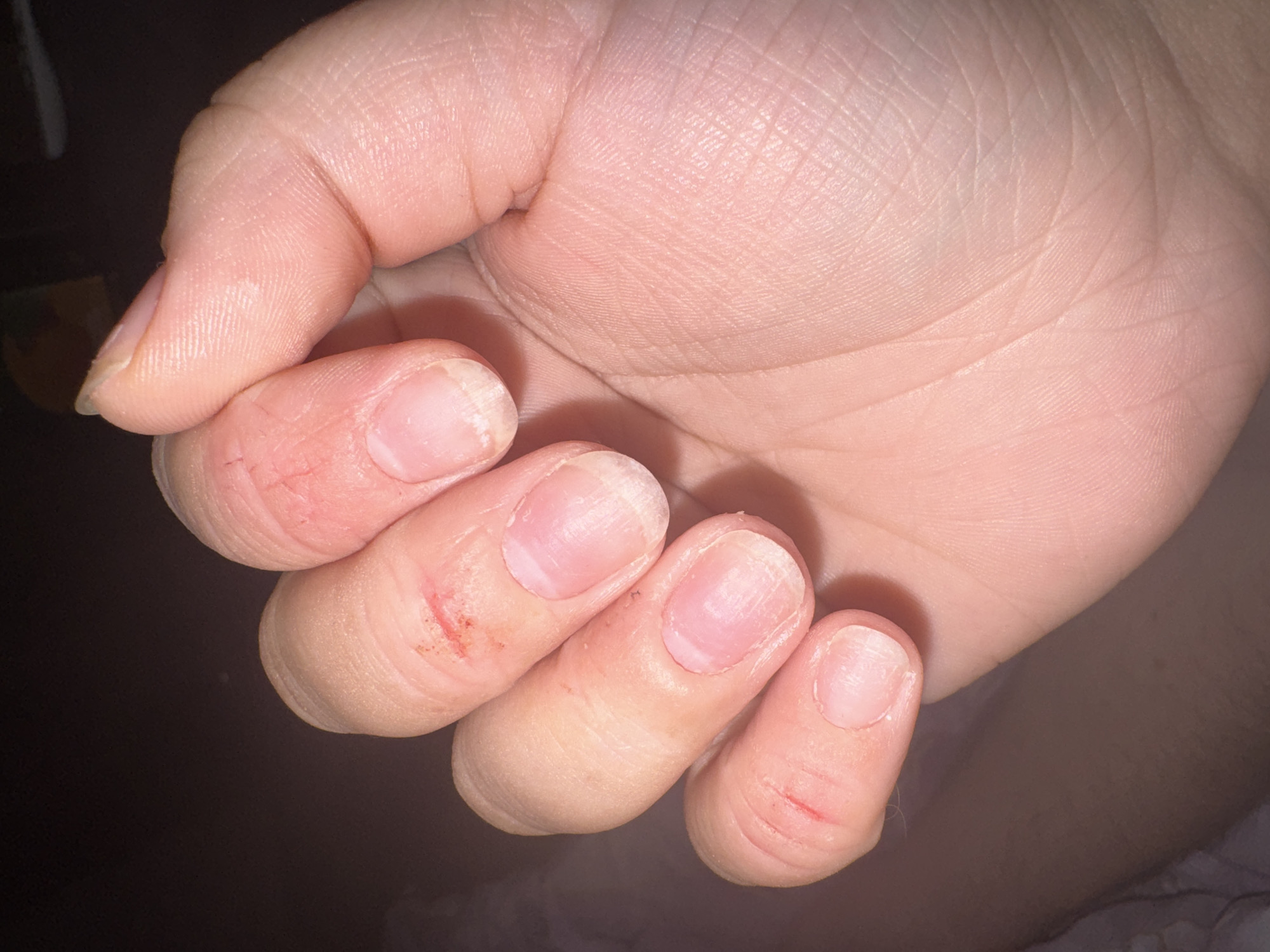 The image displays a close-up view of a human hand, specifically the fingers and palm. Several fingers show minor injuries, including small cuts and abrasions, some with dried blood visible. The fingernails appear short and unpolished. The skin texture of the hand is clearly visible, showing lines and pores. The background is dark and out of focus, making it impossible to identify any specific environment or location, including Saratov, Russia. No actions or interactions are depicted, as the image focuses solely on the static state of the hand.
