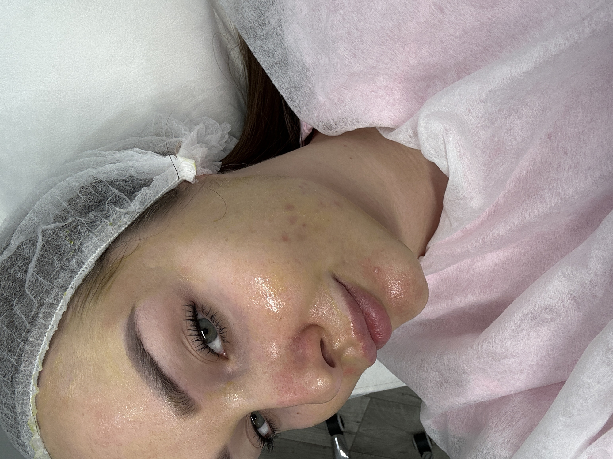 A young woman is lying on a treatment bed, likely in a beauty salon or clinic, possibly in Chaikovsky, Russia. She is wearing a white surgical hair net and is draped with a pink disposable sheet. Her face appears to have a yellowish liquid on it, potentially a facial mask or treatment product. She has visible acne and redness on her face, particularly around her nose and cheeks. Her eyes are open and looking slightly upward. There is a white pillow or cushion underneath her head, and a metallic object is visible under the sheet on the right side, possibly part of the treatment bed or a nearby stool.
