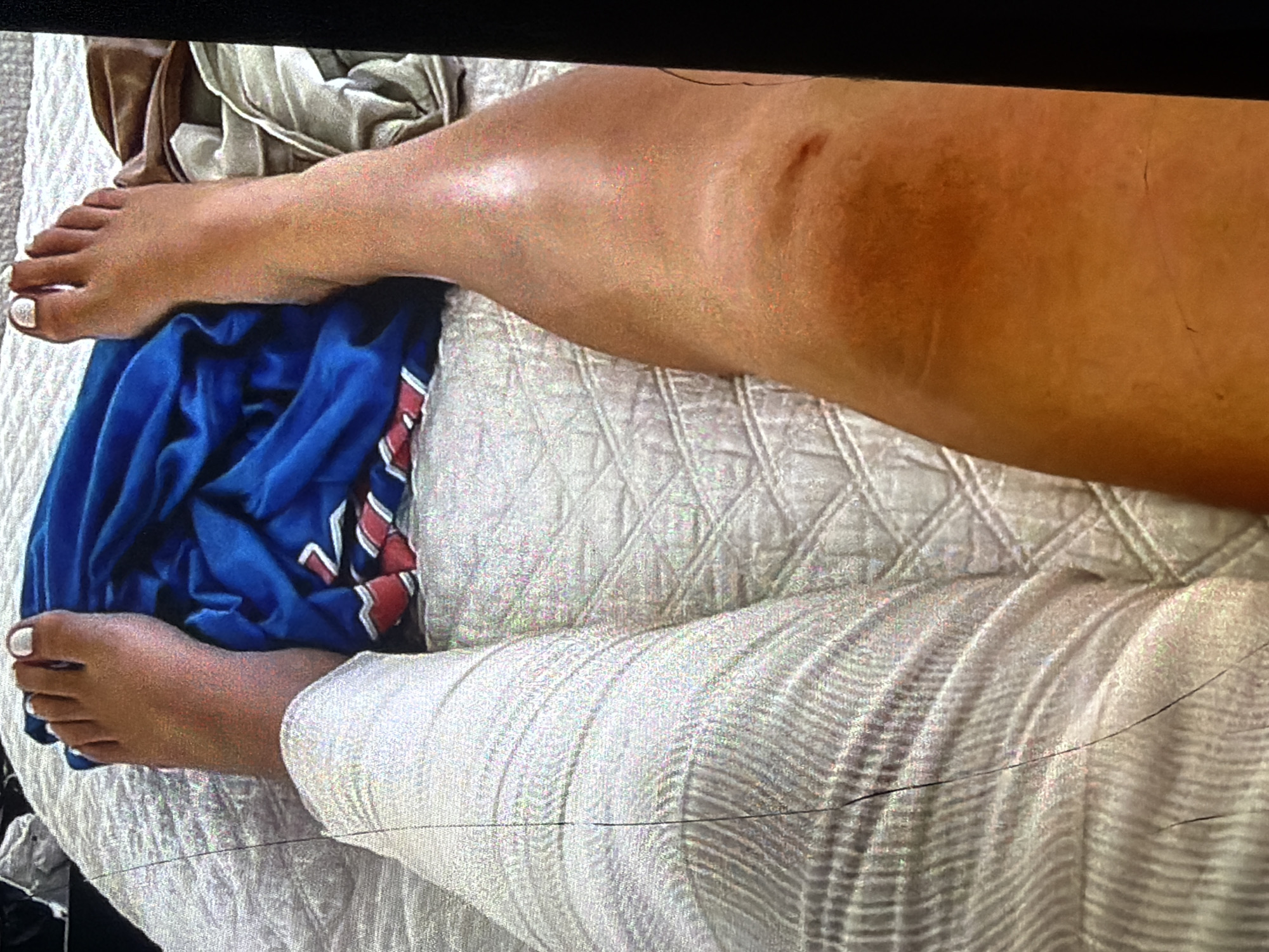The image shows a person's legs from the knees down, with the left leg wrapped in white fabric, possibly a bandage or compression sleeve, and the right leg bare. A blue garment with red and white stripes is draped between the legs. The person is lying on a white, quilted surface. The right leg shows a noticeable bruise on the shin and knee area, with a darker, reddish-brown discoloration. The background is out of focus, but appears to be a bed or sofa. The scene is domestic and informal. There are no specific indicators of location in Bukuru, Nigeria.
