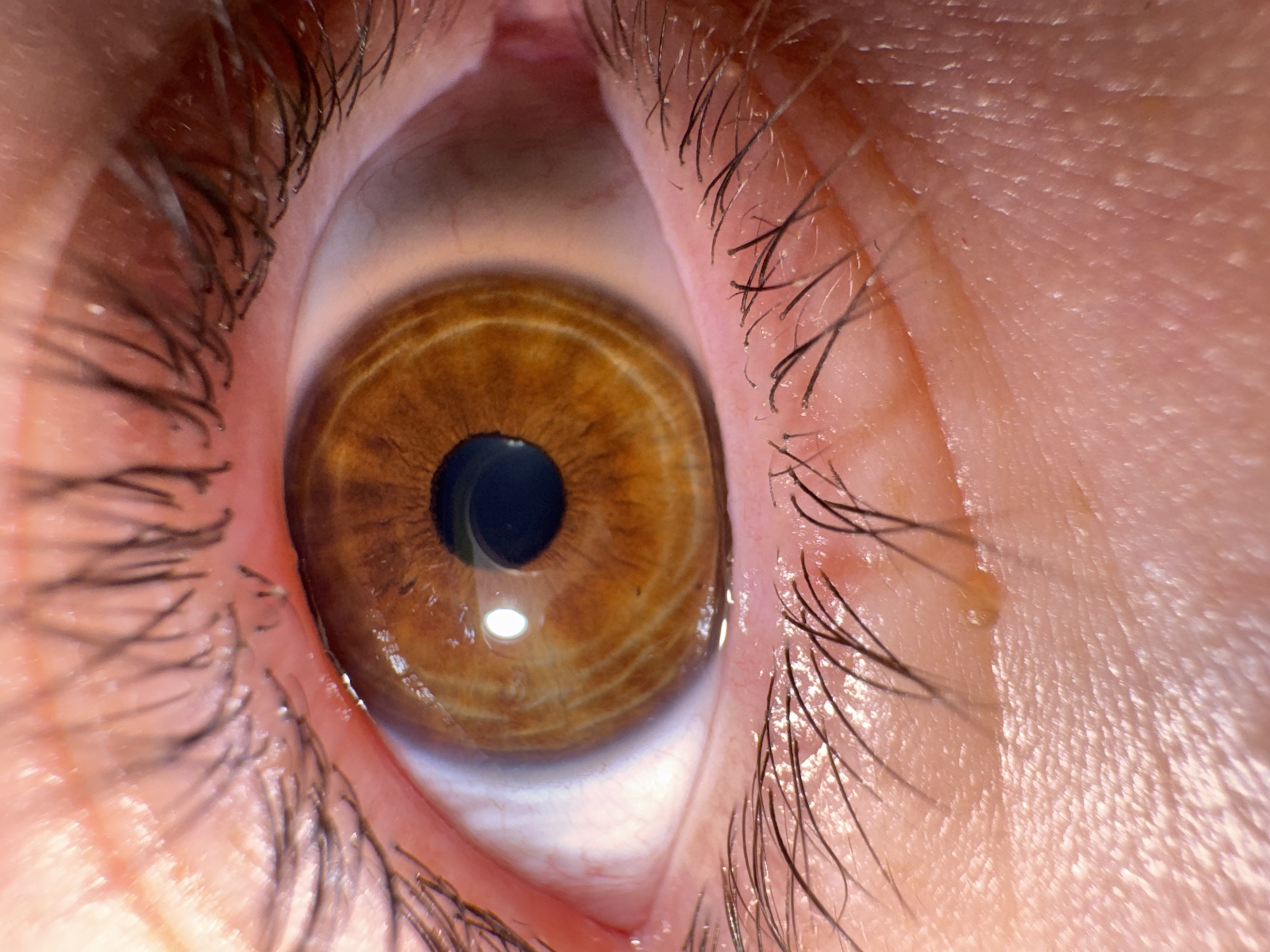 A forensic close-up image depicts a single human eye, likely the right eye, in an unknown location. The iris is a rich medium-brown with distinct radial striations, surrounding a centrally positioned, dark, circular pupil. A prominent, circular reflection of a light source is visible on the cornea, slightly superior and temporal to the pupil. The visible sclera (white of the eye) is off-white with a mild pinkish hue from visible blood vessels. Both upper and lower eyelids are detailed, showing light-toned skin with fine texture and pores. Numerous dark eyelashes are present on both lids, with some small white particulate matter adhering to the upper lashes and eyelid margin. The lower eyelid exhibits a small, yellowish-orange lesion or debris just below the lash line towards the nasal aspect. A clear tear droplet is visible adhering to the inner corner of the lower lash line. The eyelid margins appear slightly reddened and moist.