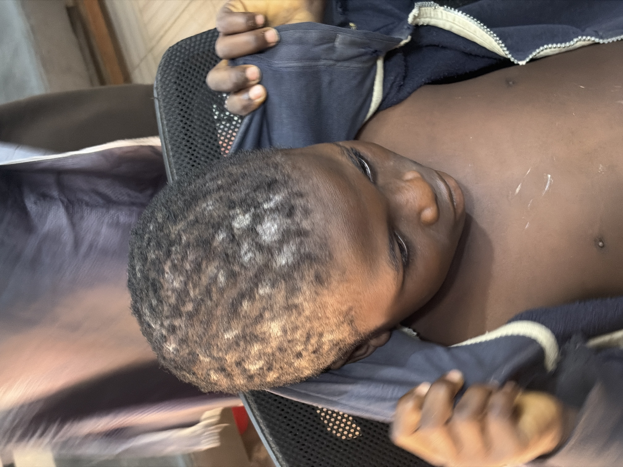 An overhead view captures a young individual, likely a child or adolescent, lying in a reclining position, possibly on a bed or a mesh-backed chair. The subject has dark skin and short, dark hair with some lighter variations. Their head is positioned towards the left side of the frame, and they are looking upwards and slightly to the right with a neutral expression.
The individual's upper body is partially covered by a dark blue garment, possibly a jacket or sweater, which has a distinct light-colored (beige or white) trim along its edge. Their hands are visible, holding onto the fabric of this garment. A significant portion of their bare torso is visible, showcasing dark skin with several scattered light-colored smudges or marks, which could be dried powder or a similar substance. A small mole or bump is also noticeable on the upper chest area.
The person is supported by a black mesh material, consistent with a chair or part of a bed frame, visible along the left and bottom edges of the image. In the background, to the right, a light-colored fabric or sheet is draped, indicating an indoor setting. The overall lighting suggests it is daytime. There is no visible text in the image. The scene conveys a sense of quiet or rest within an indoor environment in Jos, Nigeria.