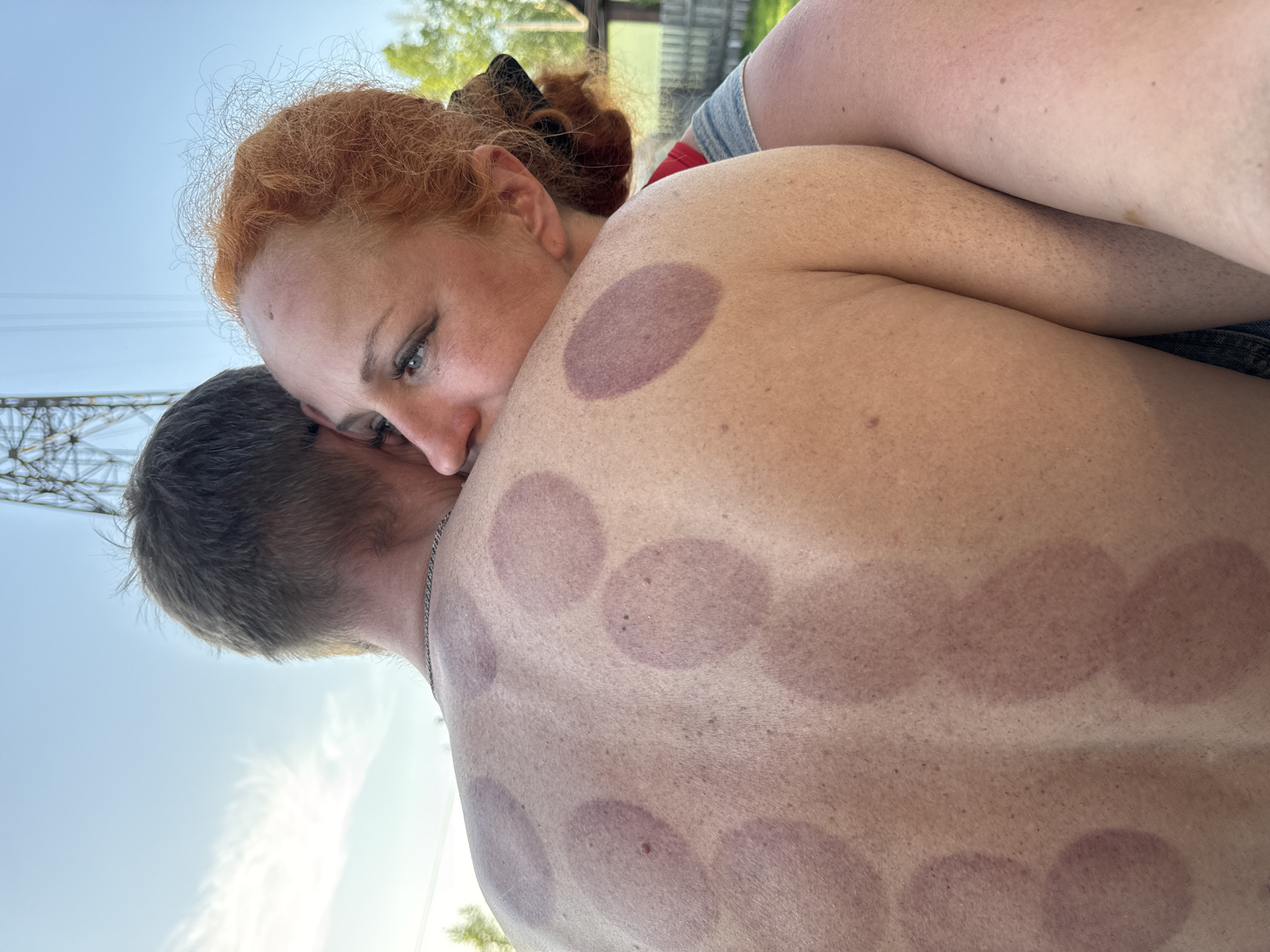 The image shows a red-haired woman with fair skin embracing a man with short, graying hair. The man's back has multiple circular bruises, likely from cupping therapy. The background suggests an outdoor setting with a metal tower structure visible against a blue sky. The scene appears to be in Chaikovsky, Russia.