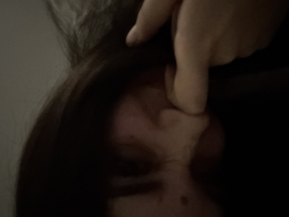 The image shows a person with dark hair partially visible on the left side. A hand is positioned above the face, with a finger pointing downward towards the cheek. The person's face is lit unevenly and partially obscured by shadows, revealing the nose and part of the mouth. Moles or blemishes are visible on the cheek and chin. The overall lighting is dim, which affects the clarity of the image.