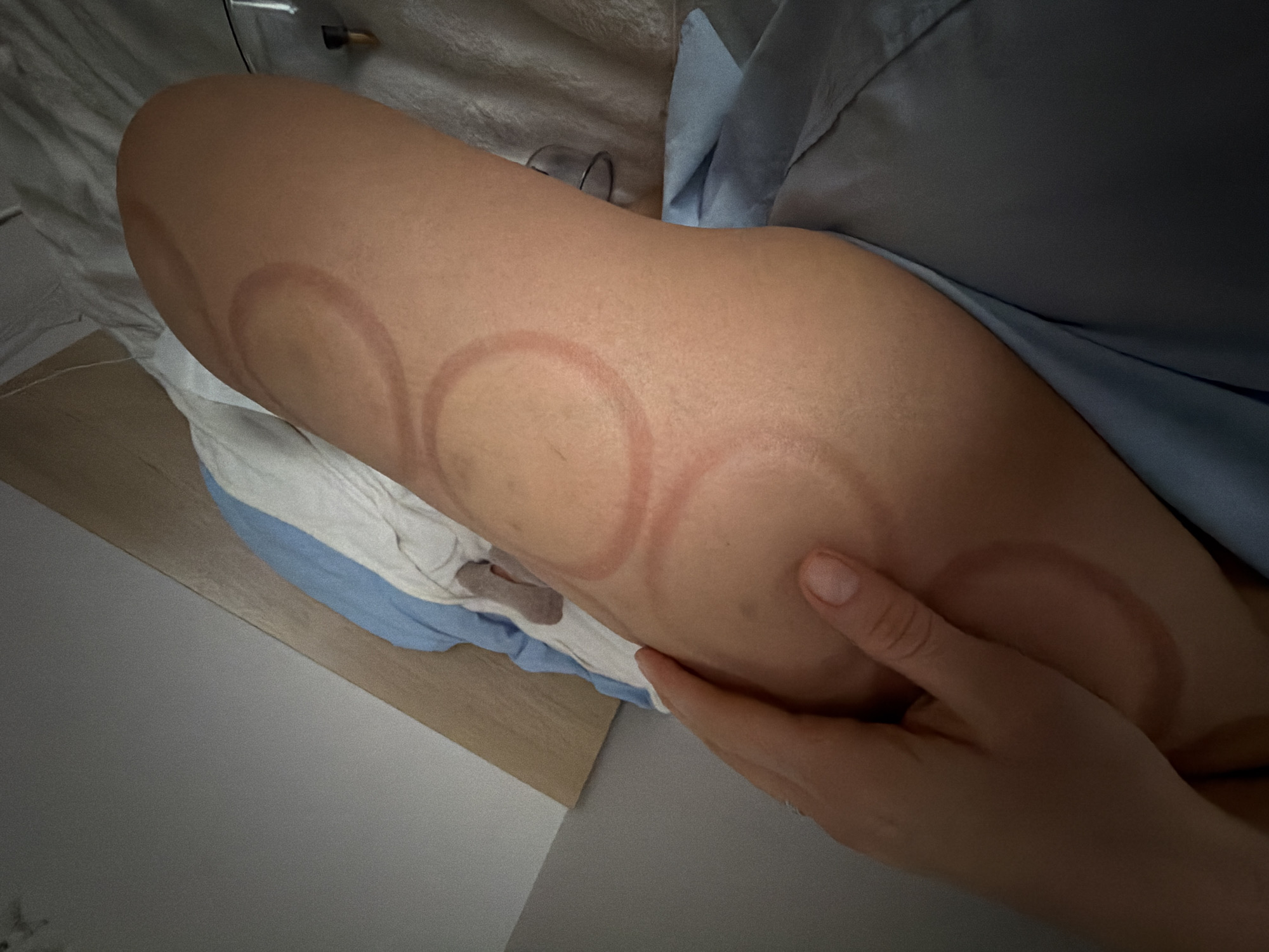 The image depicts a person's thigh with multiple circular marks consistent with cupping therapy. The leg rests on a bed covered with white and blue bedding. A hand is visible, seemingly touching the thigh. The setting appears to be indoors, possibly a medical or personal space. The location is Unknown, Unknown.