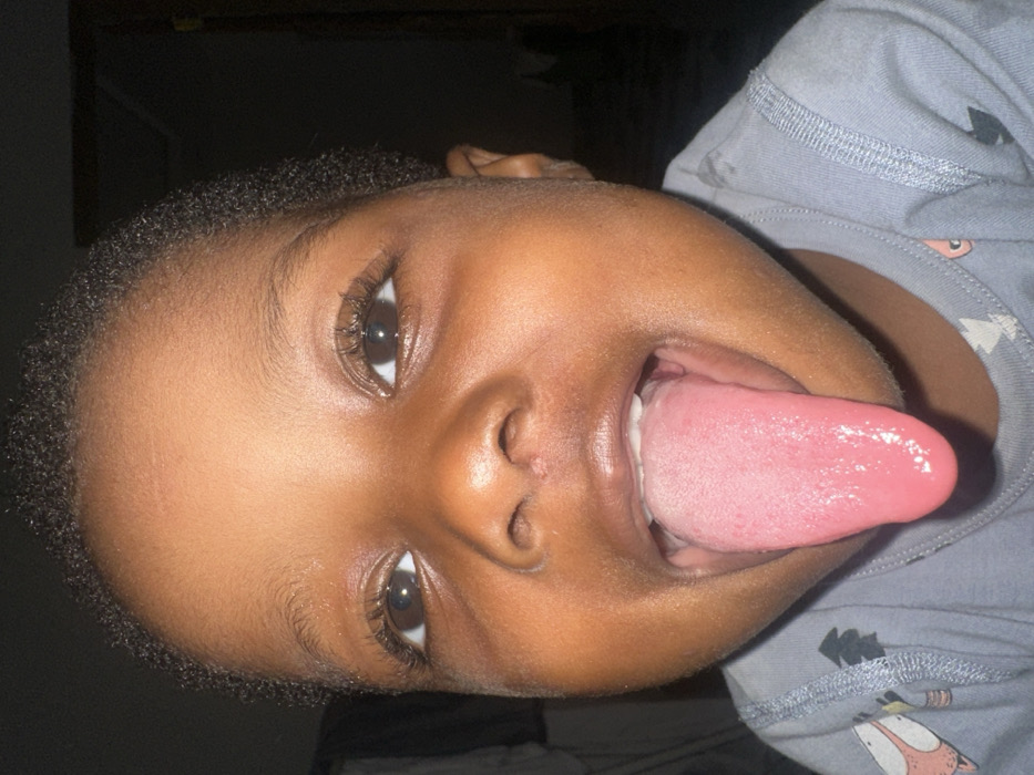 A close-up, head-and-shoulders portrait depicts a young child with a dark complexion, short dark curly hair, and brown eyes. The child is looking directly forward, mouth open, with a pink tongue fully extended. A small lesion or scab is present on the nasal bridge. The child is wearing a light-grey long-sleeved garment featuring faint, light-toned graphic elements on the left shoulder area. The background is dark and appears out of focus, suggesting an indoor setting with low or ambient lighting, while the subject is well-lit. The scene is located in Ilishan, Nigeria.