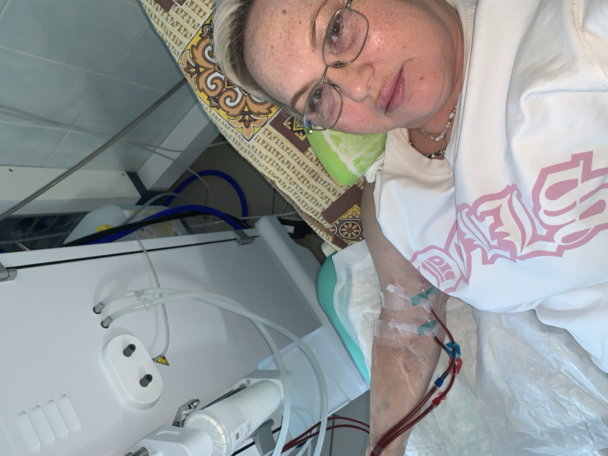 The image depicts a woman undergoing a medical procedure, likely hemodialysis, within a clinical setting in Chaikovsky, Russia. She is lying down, positioned on a patterned pillow with a green section. The woman has blonde hair, wears metal-framed glasses, and has freckles visible on her face. Her expression is neutral as she looks towards the camera. Around her neck are two beaded necklaces. She is wearing a white t-shirt featuring a prominent pink, stylized graphic design across the chest, which is difficult to decipher precisely.
Medical tubing is clearly visible connected to her left arm, with distinct red and blue lines indicative of blood flow for dialysis. Clear adhesive tape secures the cannulae to her arm, which shows visible veins. A white absorbent pad is placed underneath her arm.
To the left of the woman, a white medical machine, consistent with a dialysis unit, is prominently featured. It has various clear tubes, connectors, and a white cylindrical filter. A small yellow triangular warning sticker with an exclamation mark is affixed to the machine. In the background, light-colored ceiling tiles are visible, along with other equipment and blue hoses. The setting appears to be an indoor medical environment, characterized by functional equipment and lighting.