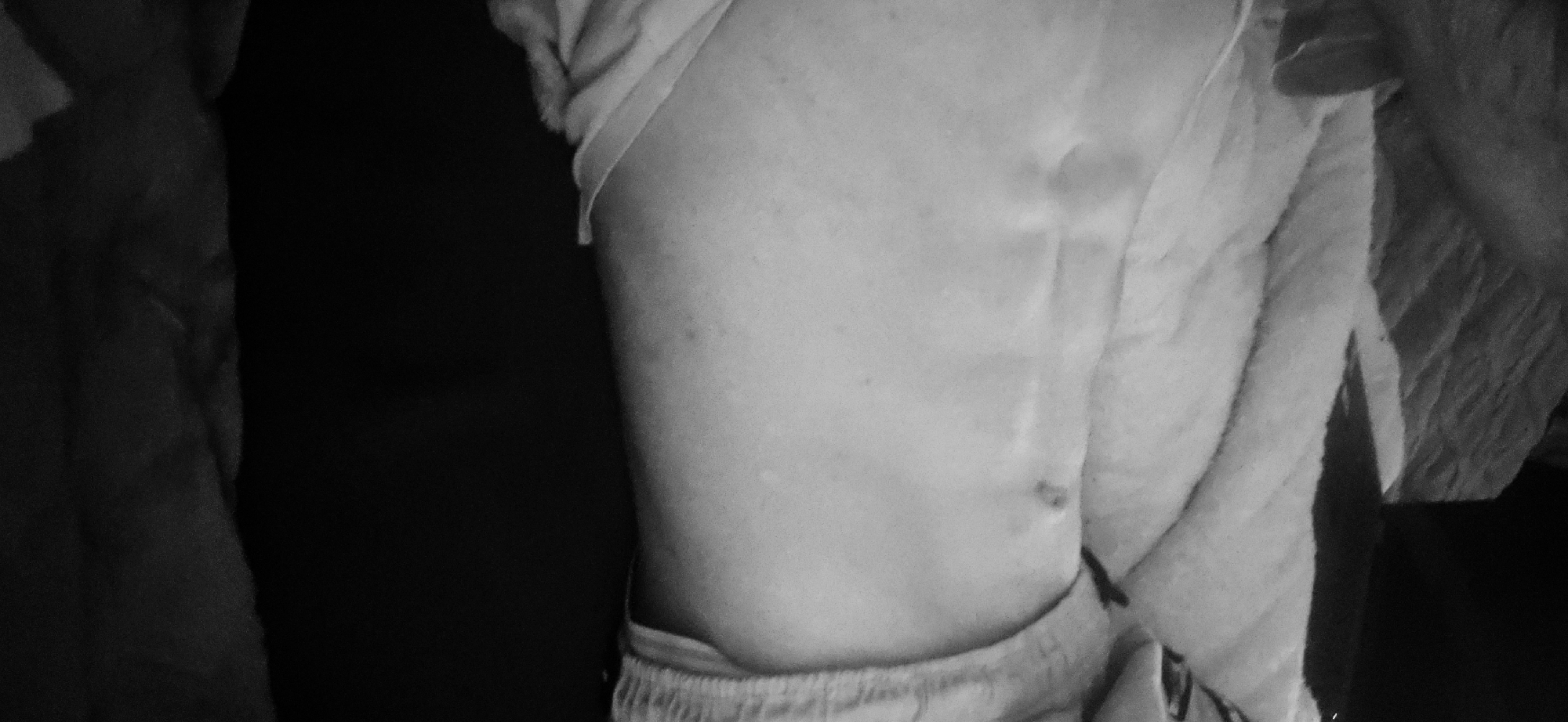 This black and white, close-up image captures the upper left side of a person's torso, from the chest area down to the waist. The subject's light-toned skin is prominently displayed, suggesting clothing has been pulled up or aside, likely a t-shirt or tank top, the edge of which is visible near the shoulder. Light-colored shorts or sweatpants are visible around the person's waistline.
A distinctive vertical indentation or scar is visible on the person's side, running down the torso. Below this, closer to the waist, there is a smaller, darker mark on the skin, possibly a mole or another scar. The skin also shows a few scattered, minor blemishes or freckles.
On the far right of the frame, a textured, light-colored fabric, resembling a towel or blanket, is partially visible. The left side of the image and much of the background are in deep shadow, indicating a dimly lit indoor setting. No specific activity or event is taking place, and no emotions are discernible from the partial view of the body. There is no visible text. The low light conditions suggest the photograph may have been taken during the evening or night. The image does not contain any specific location cues related to Plovdiv, Bulgaria.
