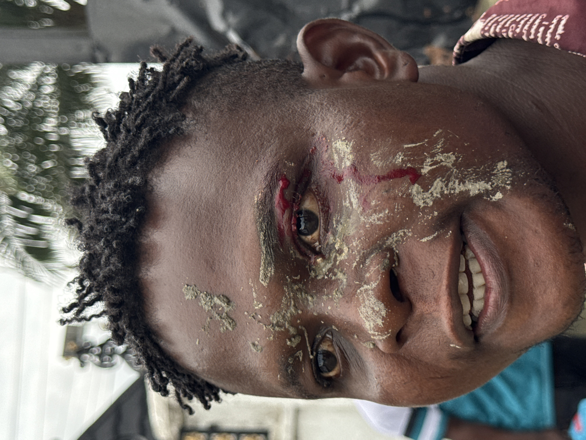 A close-up, waist-up shot shows a young Black man's face in a street in Ado, Nigeria, with his right eye bleeding. The man has dark skin and dreadlocks, with dirt and what appears to be dried blood smeared across his face, particularly around his right eye. His mouth is slightly open, revealing his teeth. In the background, out of focus, are glimpses of buildings and vegetation, suggesting an outdoor urban environment. The man is wearing a maroon and white patterned shirt.
