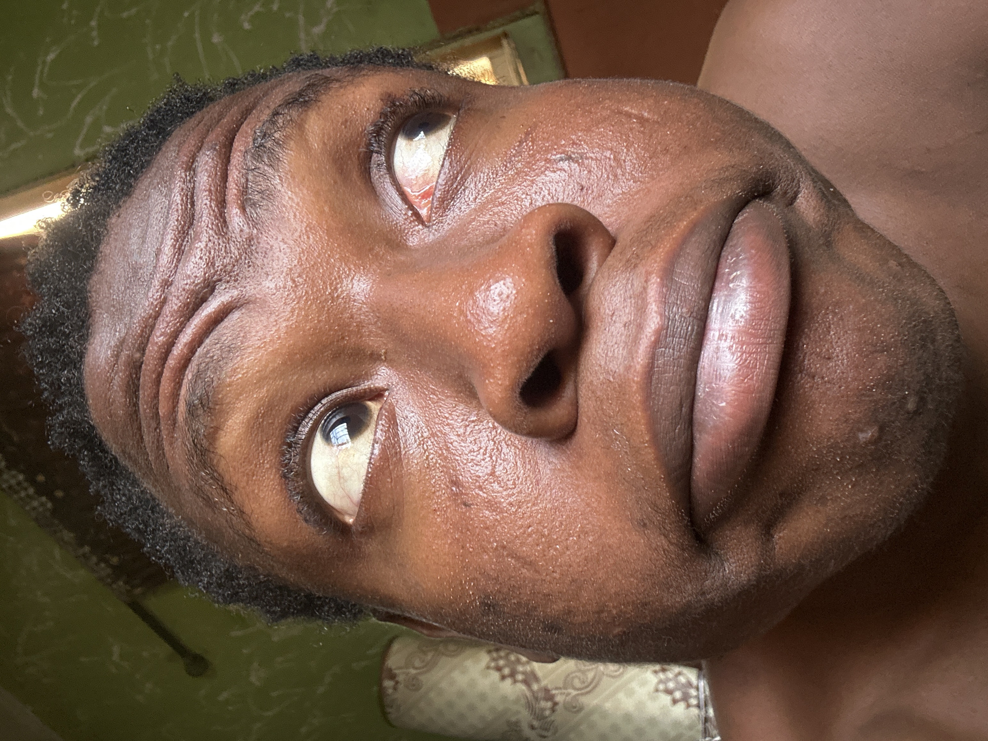 The image is a close-up, rotated portrait of a person with dark skin, likely male, captured from the forehead to the mouth, with parts of the neck and shoulder also visible. The person's head is significantly tilted and rotated, causing them to appear to be looking sharply upwards and to the right from the viewer's perspective.
The subject has short, dark, curly hair visible at the hairline. Their forehead displays pronounced horizontal wrinkles, indicating a raised brow or muscle contraction. The eyes are a central feature, with the whites (sclera) being highly prominent and showing visible blood vessels, which lend a slightly reddish cast, particularly in the eye on the viewer's left. Reflections of a window or light source are distinctly visible in the dark irises. The nose is broad, and the lips are full and slightly parted, exhibiting a natural pinkish-brown hue and some texture. The dark-toned skin across the face and visible neck area shows visible pores, fine hairs, and a subtle sheen, possibly due to sweat or natural oils.
The overall expression is ambiguous, potentially suggesting intense focus, an uncomfortable moment, or a deliberately posed gaze given the unusual angle and eye position.
The background is generic and indistinct, featuring a green surface with faint white patterns in the upper portion, and a lighter-colored, patterned fabric, possibly bedding or a pillow, visible at the bottom of the frame. The lighting suggests an indoor setting, possibly with natural light. There is no visible text within the image. The specific location is unknown.
