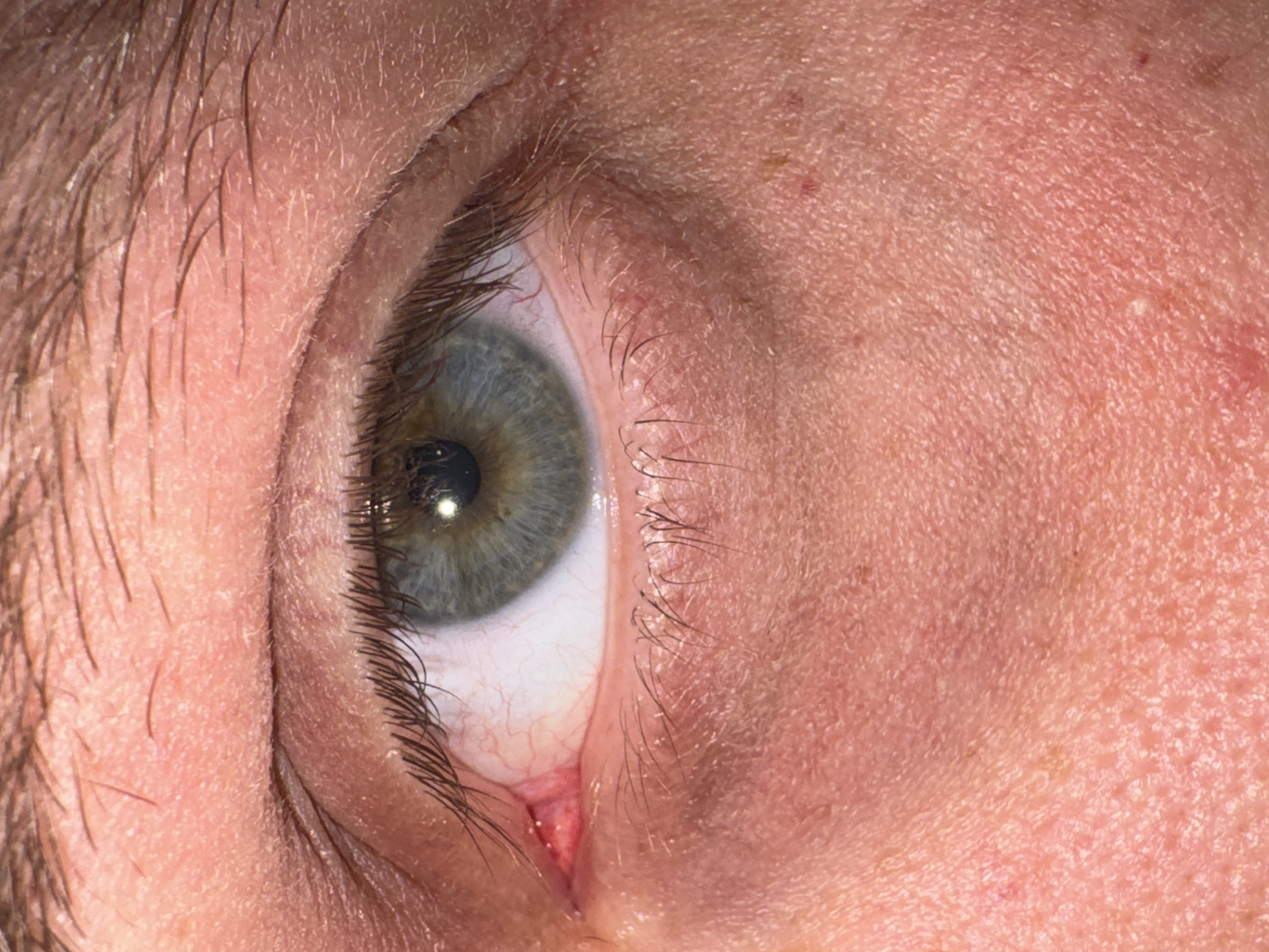 A close-up, high-resolution image captures a human eye and the surrounding facial skin, viewed from an oblique angle. The eye, positioned centrally, features a distinct green or hazel iris with a dark pupil that shows a bright, circular reflection, likely from a light source. The sclera (white part of the eye) is visible, particularly towards the inner corner, where numerous small, red blood vessels are apparent. The lachrymal caruncle, a small, pinkish-red nodule, is prominent at the inner corner of the eye.
Dark, long eyelashes frame both the upper and lower eyelids. Above the eye, dark, coarse eyebrow hairs are visible, some standing erect, indicating the presence of an eyebrow and likely part of the forehead. The skin in the foreground and surrounding the eye appears light-toned and exhibits considerable texture, including pores, fine lines, and tiny hairs. There are also several small reddish spots and some areas that suggest dryness or slight flakiness, particularly on the skin near the eyebrow and towards the temple. The overall impression is an extremely detailed, almost magnified, view of a portion of a human face. No text is visible in the image.