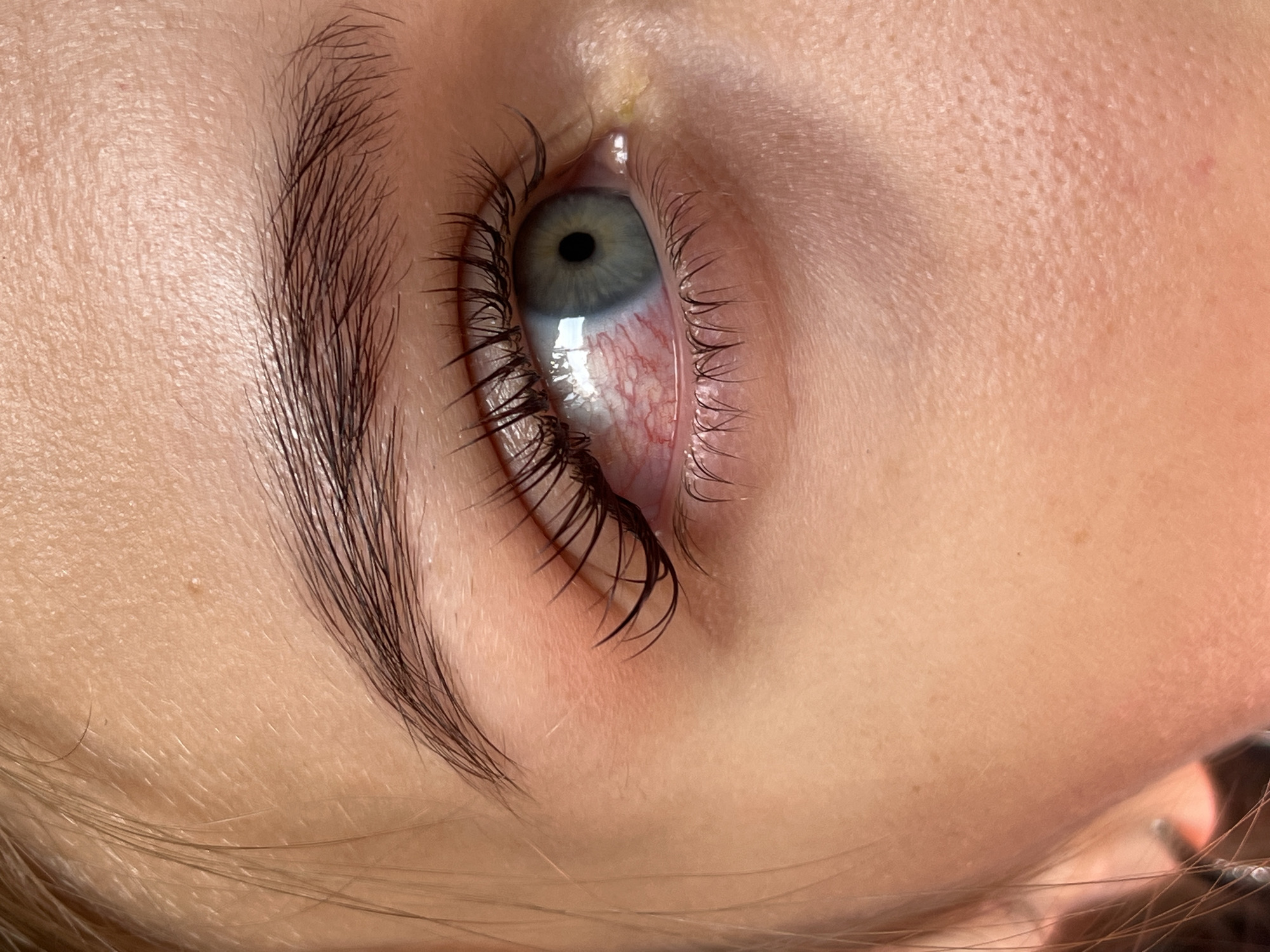 This is a very close-up, angled shot of a human eye and the surrounding skin. The eye, positioned towards the center-right of the frame, features a light blue-grey iris with a distinct dark pupil. The sclera, or white part of the eye, is noticeably red with visible blood vessels, particularly on the lower portion. The lower eyelid appears to be pulled down, exposing the red, vascularized inner surface. Long, dark eyelashes frame the eye, curving upwards.
Part of a dark, well-defined eyebrow is visible in the upper-left quadrant, composed of individual hairs. The skin around the eye is light-toned, showing texture, pores, and fine vellus hairs. A small, yellowish accumulation, possibly eye discharge, is present near the inner corner of the eye, towards the bridge of the nose. Several strands of light brown hair are visible along the bottom edge of the image, presumably belonging to the individual. The lighting is bright and even, highlighting the details of the skin and eye. No specific activity is definitively taking place, though the pulled-down eyelid suggests either irritation or an examination. There is no visible text. The image does not provide cues for time of day, weather, or specific location within the scene itself.