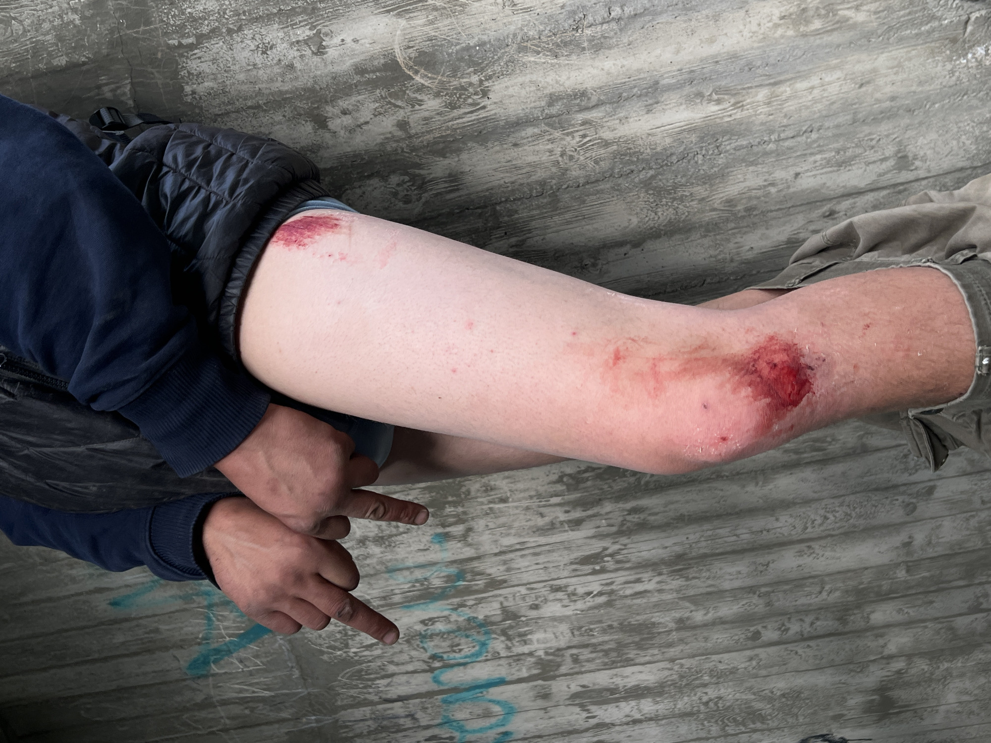 A person's left leg and hand are visible in the image. The person is wearing a dark blue jacket and tan shorts. Their left leg has multiple abrasions and scrapes, most notably on the knee and upper thigh. The abrasions on the knee are significant, showing red, raw skin and some bleeding. The person's left hand is also visible, and their fingers appear to be pointing downwards. The background is a textured concrete wall with graffiti. The scene appears to be outdoors in an urban environment.