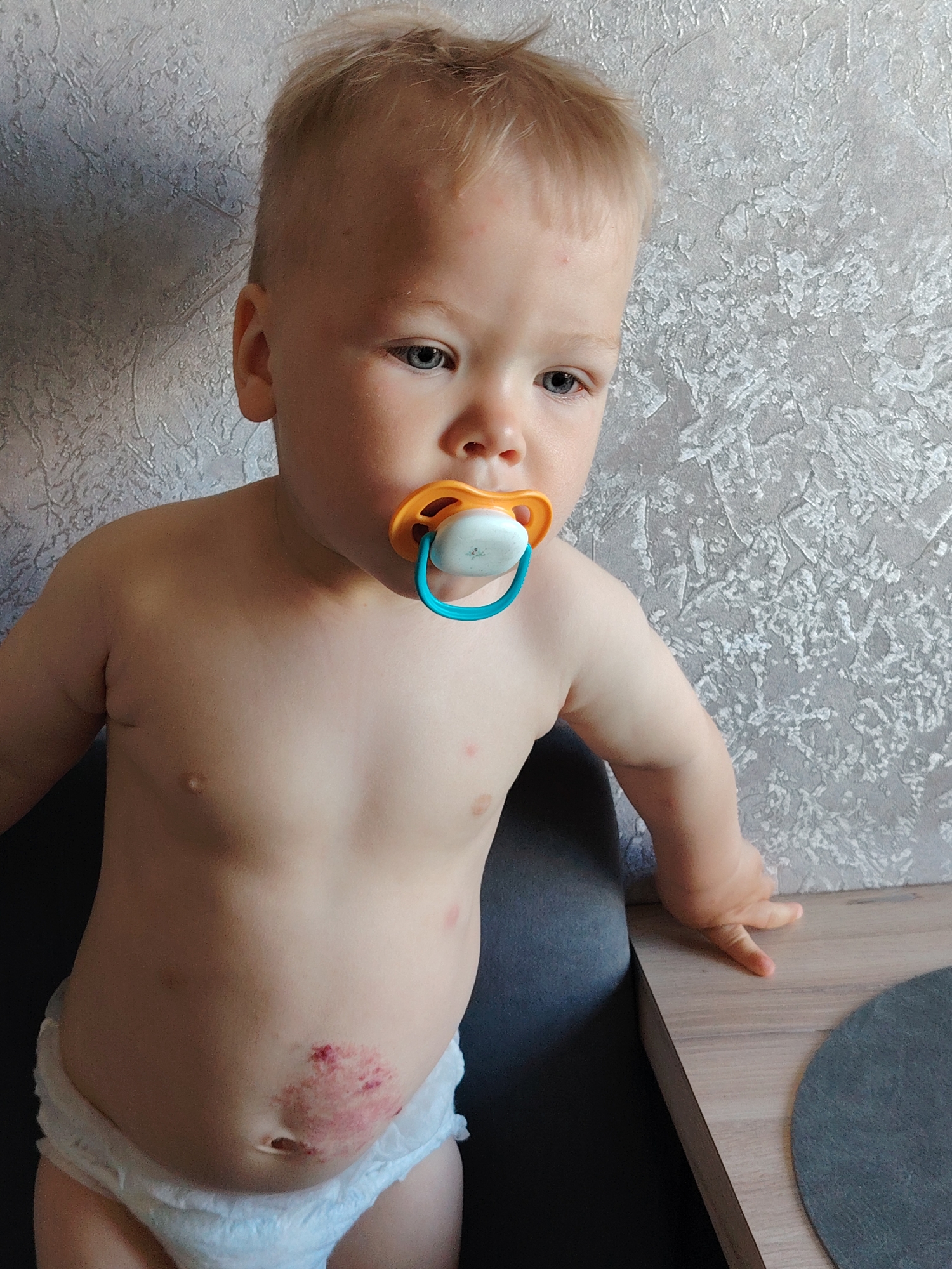 A fair-skinned toddler with light blond hair is shown from the waist up. The child has a light-colored pacifier with an orange and blue ring in its mouth. The child is wearing a white diaper. A reddish skin abrasion is visible on the child's abdomen. The child stands beside a dark gray chair and a light-colored wooden table. The wall behind the child is textured with white and gray paint. The image was taken in Chaikovsky, Russia.