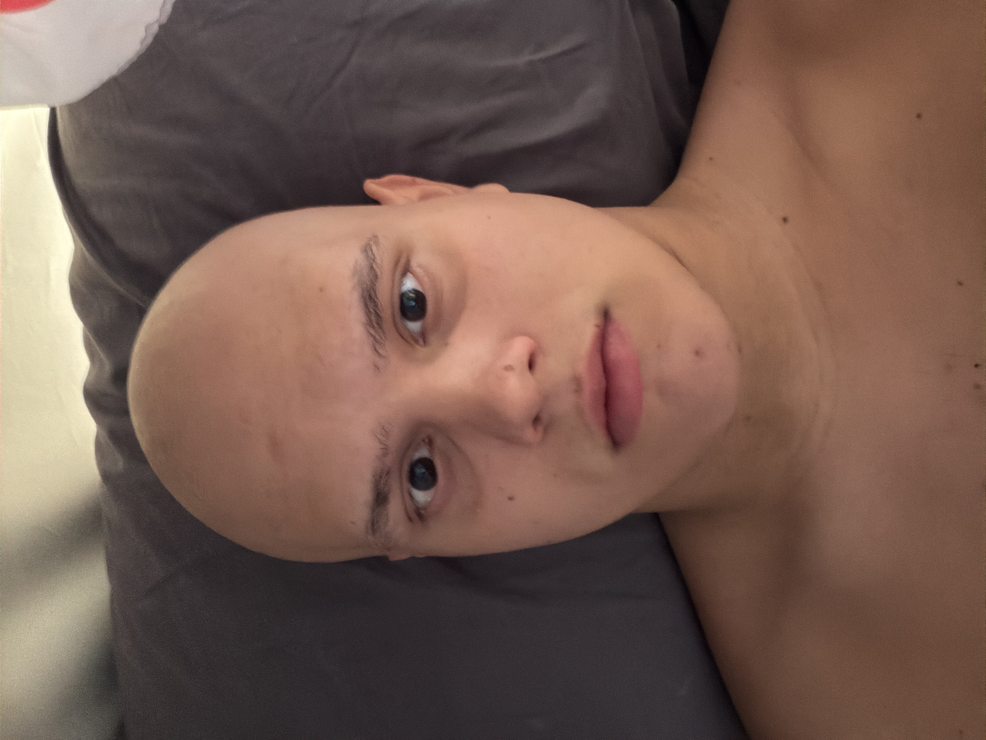 A bald person with light skin and brown eyes is lying in bed, with their head resting on a dark gray pillow. The person is looking directly at the camera with a neutral expression. The room is dimly lit, with soft shadows cast by what appears to be natural light coming from the side. The background is primarily composed of the bedding and a hint of a white object, possibly a pillow or a blanket, on the right side of the frame. There are no visible signs of the person's location in Germasogeia Municipality, Cyprus, or any other identifiable landmarks within the image.