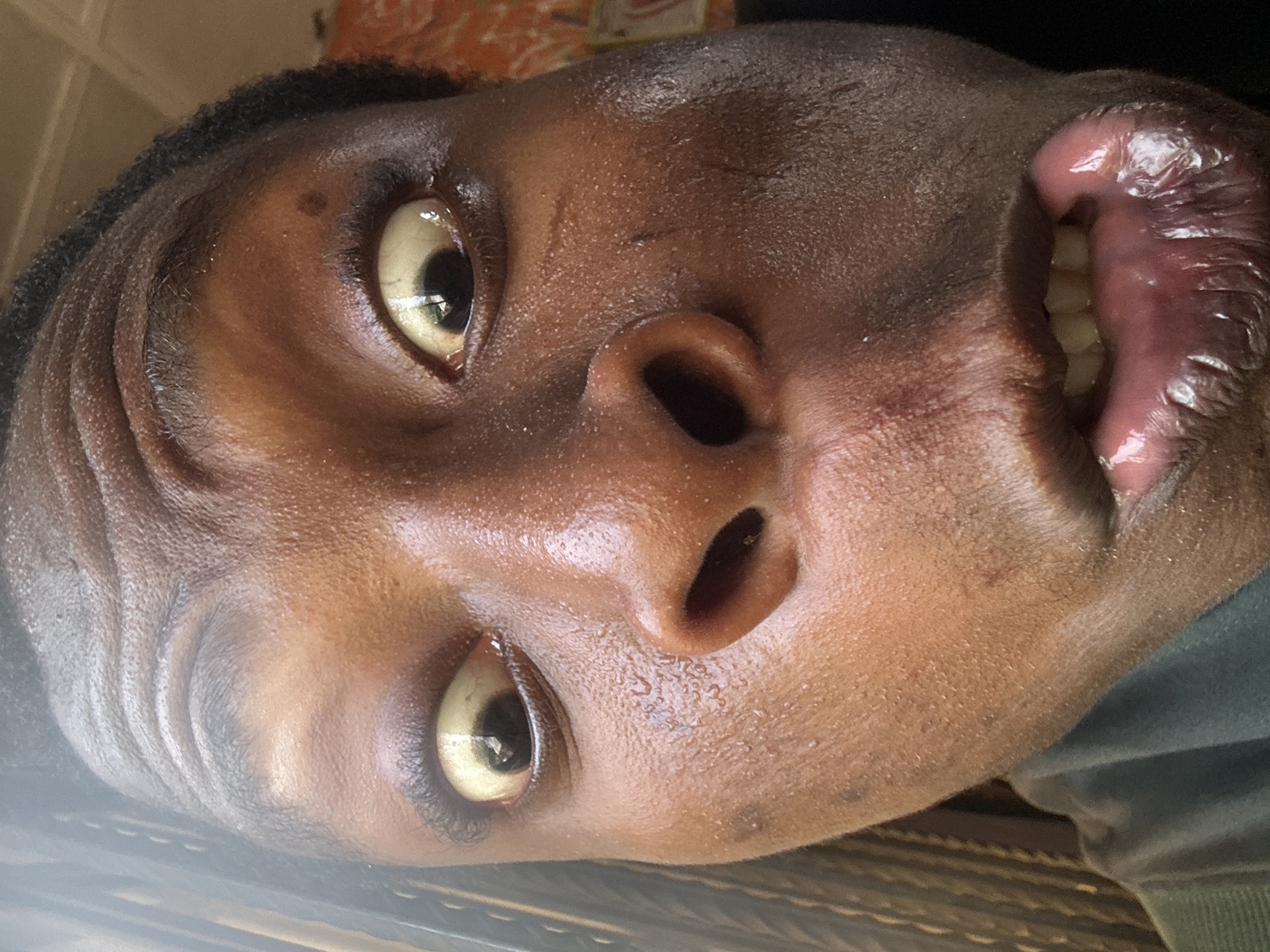 A close-up portrait of a person with dark skin, rotated approximately 90 degrees counter-clockwise. The individual's face, from the hairline to the chin, fills the frame. Both eyes are wide open, and the sclera (whites of the eyes) have a distinct yellowish tint. The irises are dark. The skin on the face appears moist and shiny, suggesting sweat or wetness, particularly on the forehead, around the eyes, and on the nose. Fine wrinkles are visible across the forehead and around the eyes. The mouth is open, revealing yellowish-white teeth, and the lips are full, appearing very wet, shiny, and possibly swollen or chapped. Short, dark, curly hair is visible along the hairline. The background is largely out of focus, showing dark areas with faint hints of an orange pattern and blurred horizontal stripes, suggesting an indoor setting. No specific activity is discernible beyond posing for the camera, possibly conveying an expression of surprise, distress, or an exaggerated emotion. There is no visible text.
