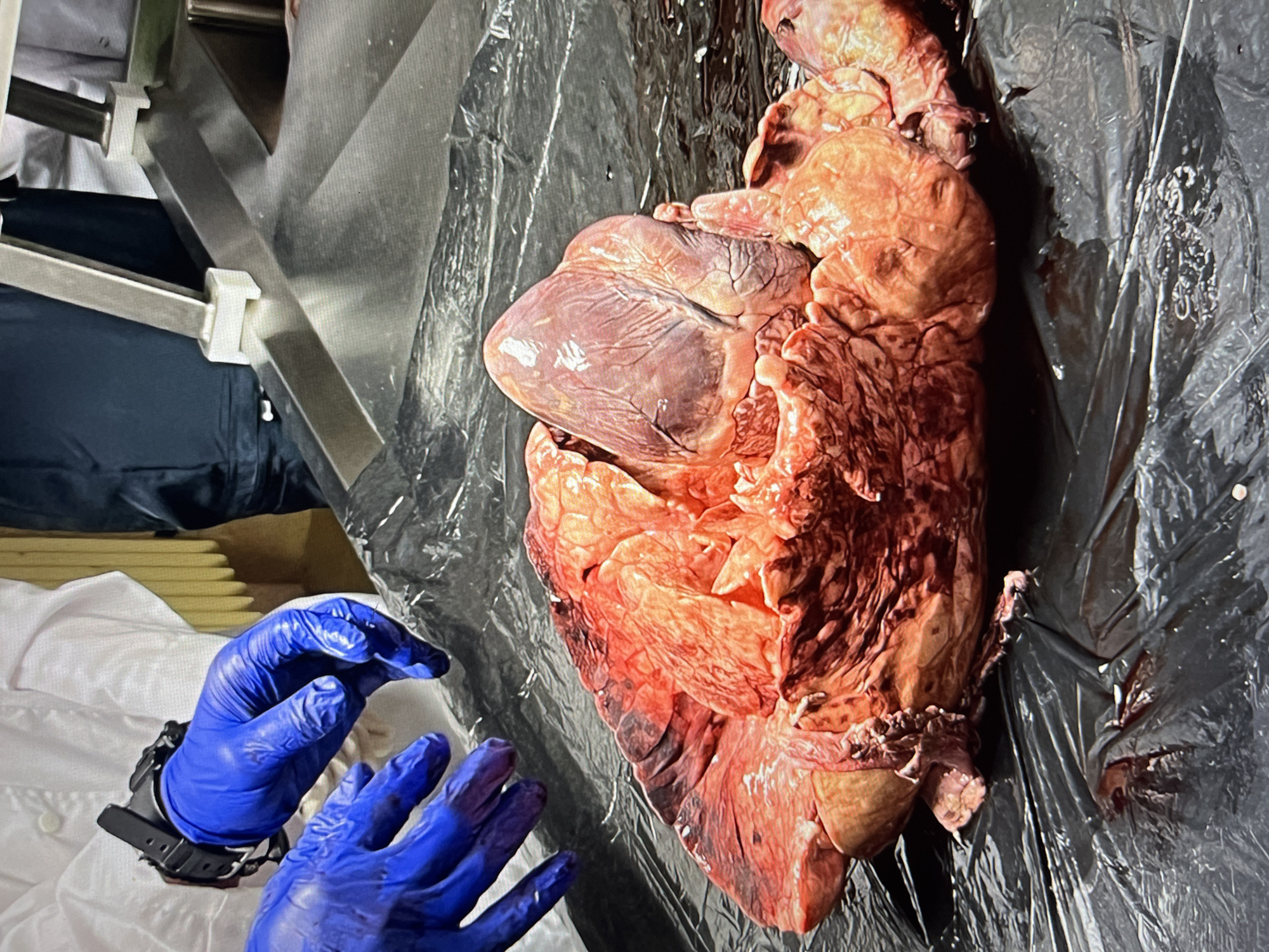 The image depicts an apparent forensic examination. A human heart and lungs are laid out on a black plastic sheet. A person wearing blue surgical gloves and a white lab coat is visible in the lower left corner. The setting appears to be a laboratory or autopsy room, with a stainless steel structure visible in the background. The city is unknown, as is the jurisdiction.