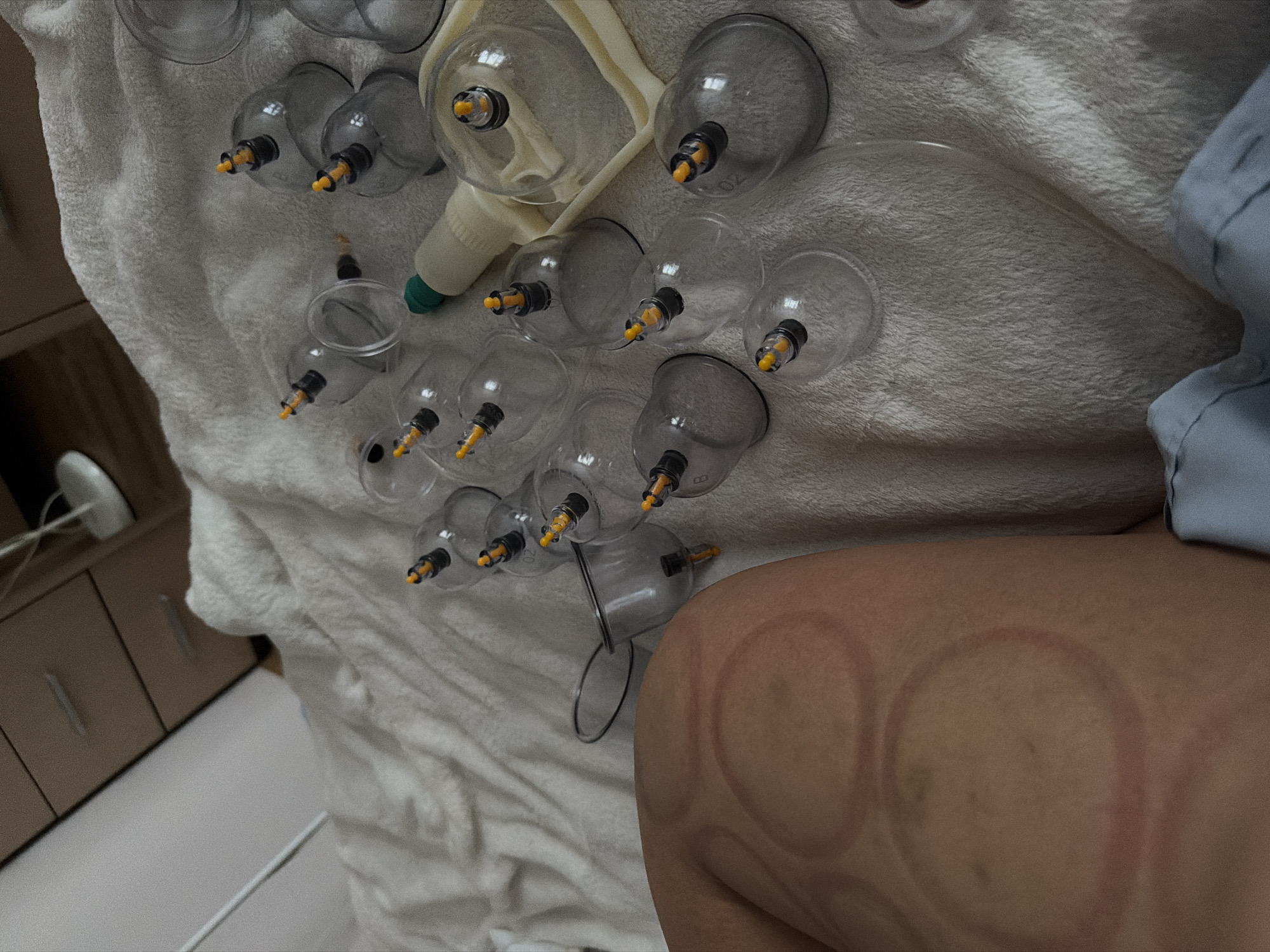 The image depicts a cupping therapy session. Clear, plastic cupping instruments are positioned on a white towel. Some of the cupping marks are visible on the patient's skin. A white device with a green handle is also on the towel. The scene appears to be in an interior setting. There is furniture (a cabinet) visible in the background on the left. It is not possible to determine the exact location in Saint Petersburg or infer any actions or interactions from this image alone.