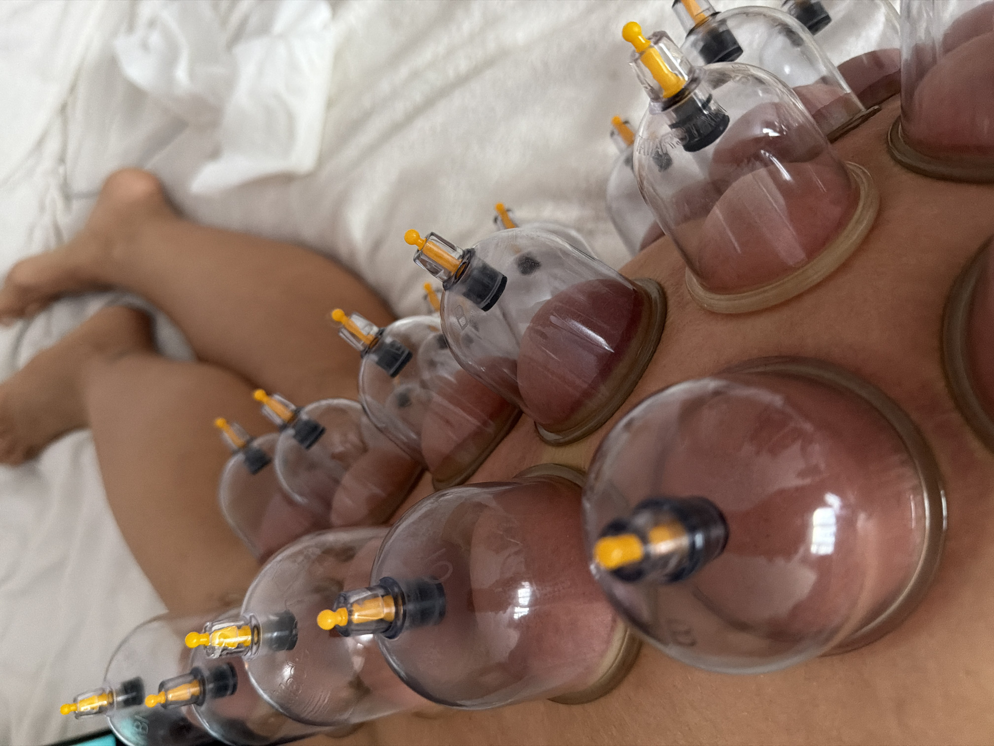 A person lies on a white bed, receiving cupping therapy on their back. Multiple clear, round cups with yellow valves are attached to their skin, creating suction and leaving reddish marks. The person's legs are visible in the lower left corner. A white towel is underneath the person. The location in the city of Saint Petersburg, Russia, is not ascertainable.