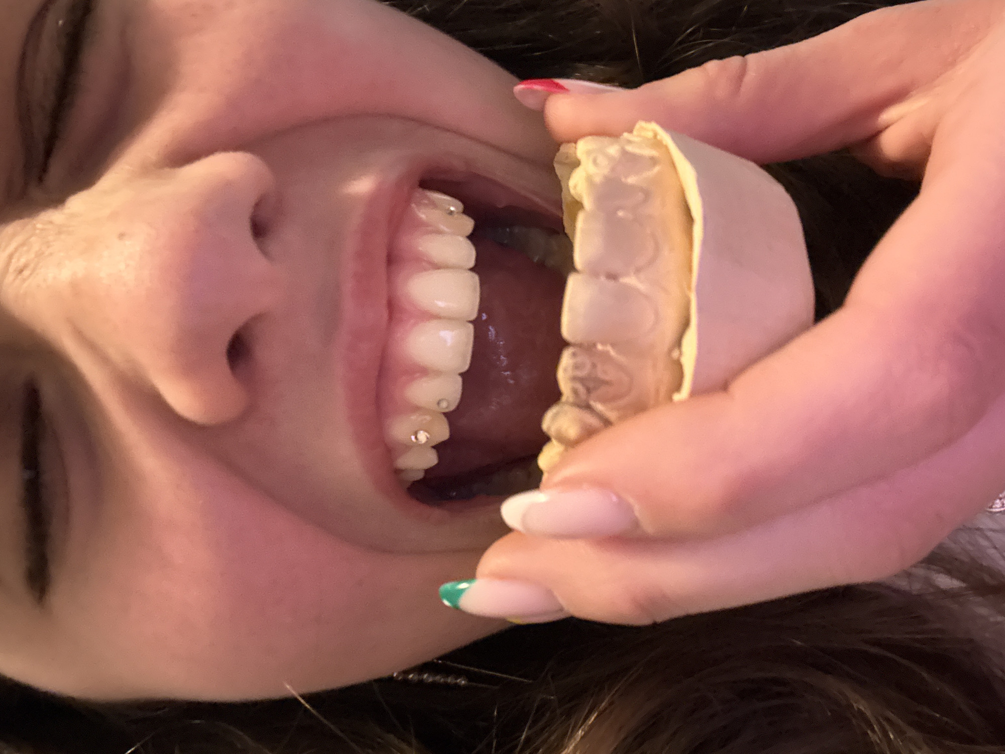 A close-up, tilted view shows a woman holding a dental aligner near her open mouth. The woman's face fills the left side of the frame; her eyes are closed, and her teeth are visible, some adorned with small, possibly decorative, gems. Her hand, with nails painted in a French manicure style with accent colors of red and green on some nails, holds the clear aligner. The aligner appears to be a custom-made dental appliance, possibly for straightening or correcting teeth. The background is blurry and provides no discernible information about a location, specifically Sofia, Bulgaria. No specific details in the image definitively place the subject in that location.