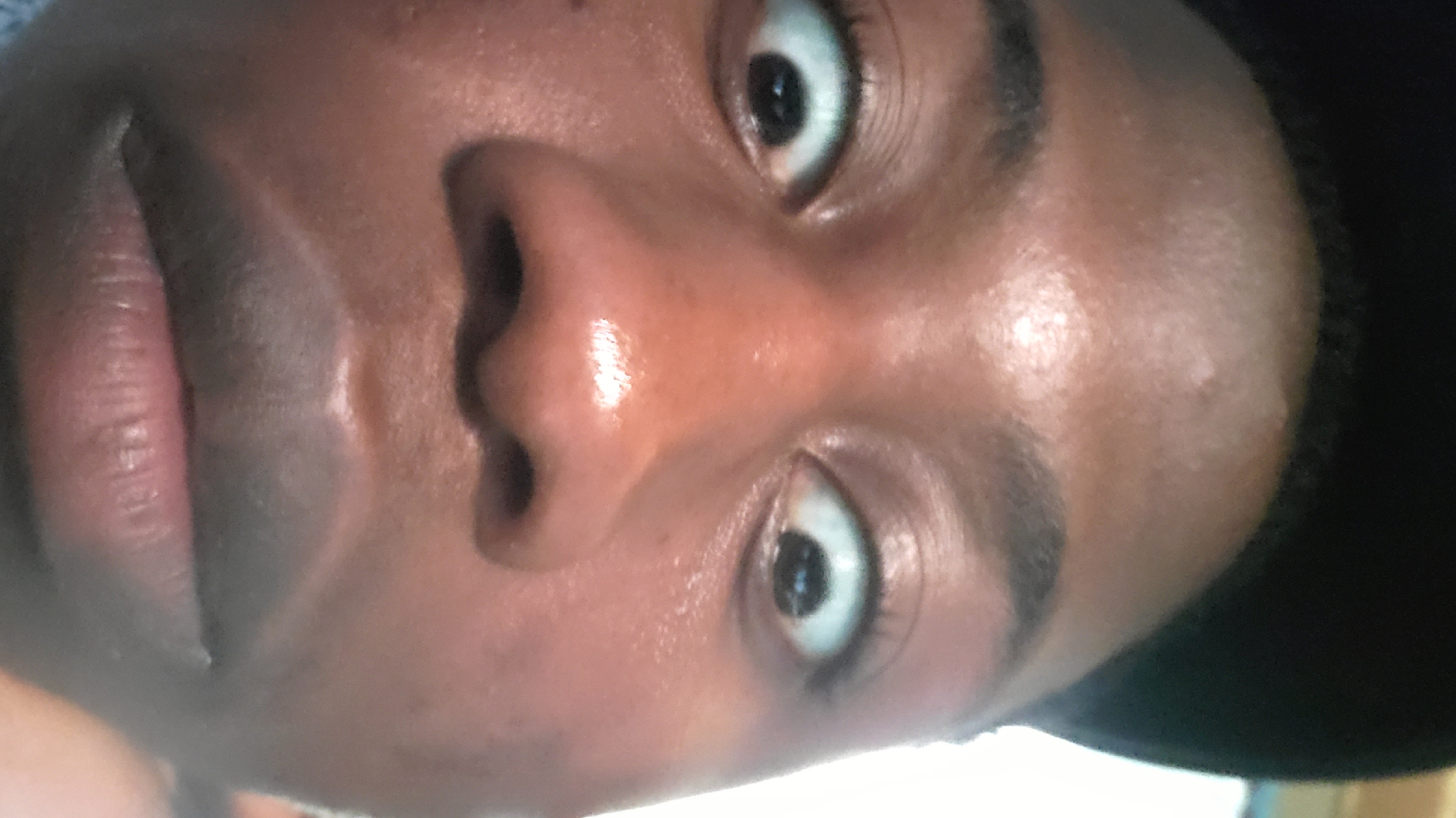The image is a close-up, vertically oriented, low-angle shot of a person's face, focusing on their nose, lips, and eyes. The lighting is somewhat harsh, highlighting the texture and slight sheen of the skin. The person appears to be looking slightly off-camera, with a neutral or perhaps slightly surprised expression, conveyed through their wide-open eyes and slightly parted lips.
The subject's skin tone is a medium brown, and there are some small blemishes or bumps visible on the forehead area. The eyes are light brown or hazel, and the eyelashes are dark and prominent. The nose is broad and well-defined, with a distinct shine on the bridge and nostrils. The lips are full and appear to be naturally colored. The subject is wearing a dark colored hat, which obscures the top of their head and casts a shadow.
The overall impression is a candid, intimate portrait that emphasizes the raw features of the face. There is no discernible background detail, nor any indication of the time of day, weather, or specific location. The focus is entirely on the facial features and skin texture.