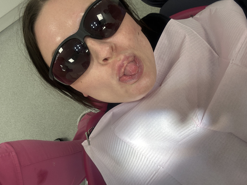 The image shows a person wearing dark-tinted safety glasses and a disposable bib, suggesting a dental or medical appointment. The person sticks their tongue out, displaying visible lingual frenulum. The setting appears to be a clinical environment with a pink dentist chair and a light-colored floor. The camera angle is slightly tilted, providing a close-up view of the face and upper body.