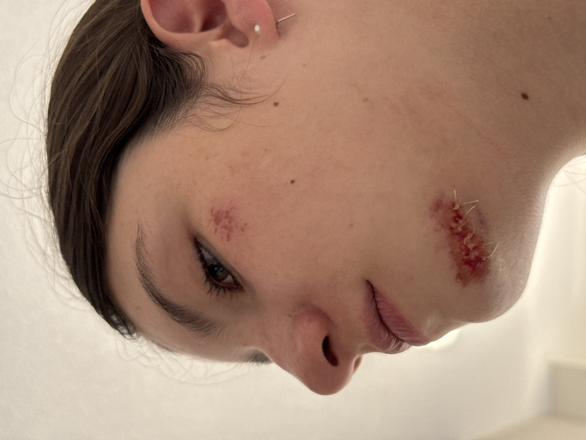A close-up, angled view of a person's face, possibly female, reveals trauma. There are lacerations on both the left cheek and right jawline. The wound on the right jawline is sutured, with visible stitches. Small freckles are observed on the person's cheek. A piercing is present in the upper ear. The background is a plain, light-colored surface. There's no information in the image to indicate the location is Vancouver, Canada.