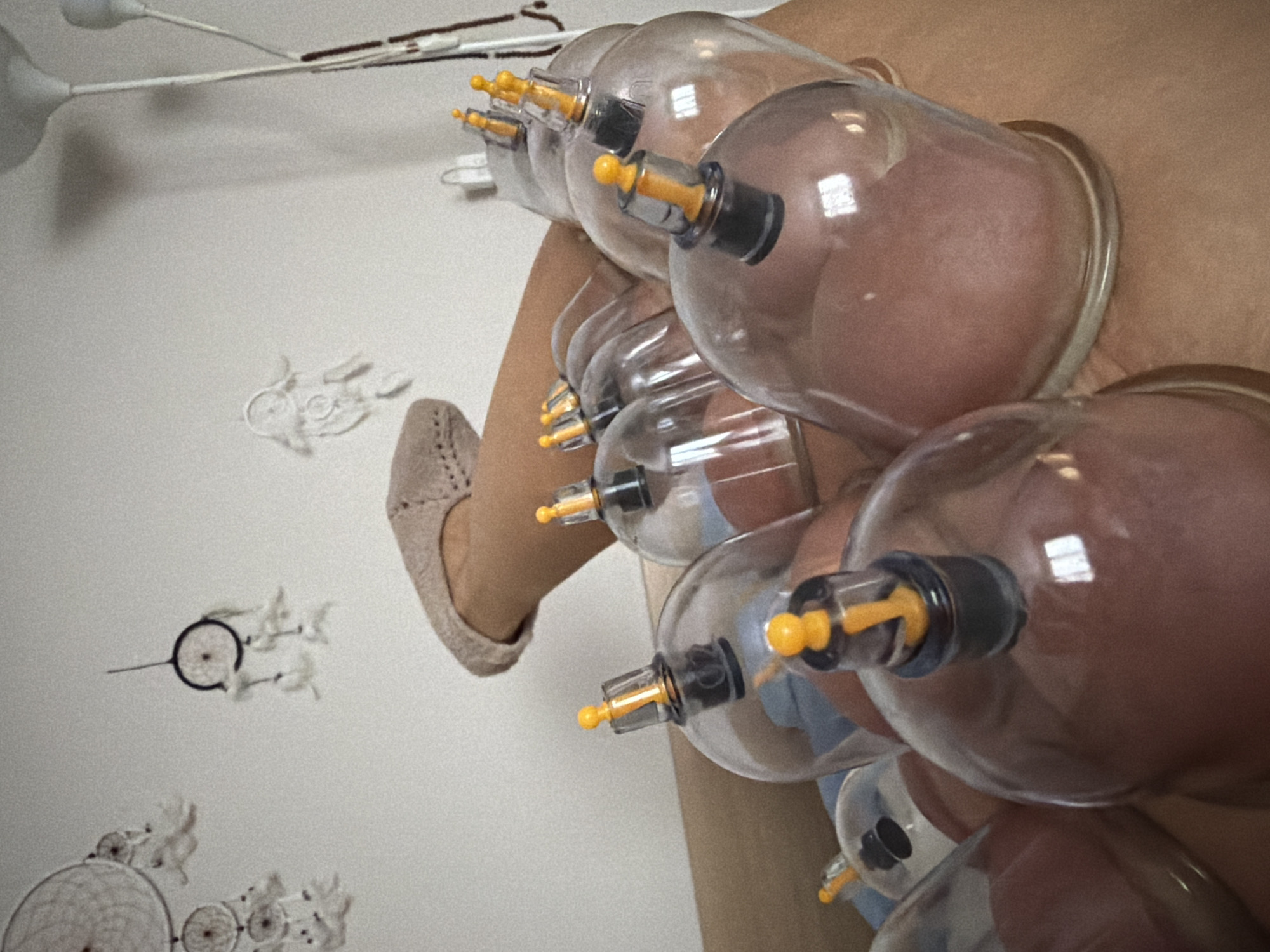 A photograph shows a person receiving cupping therapy. The person is wearing a beige shoe. Clear glass cups with yellow and black attachments are affixed to the skin, creating suction. In the background, a white wall is decorated with dreamcatchers and a light fixture is visible. The location is possibly Saint Petersburg, Russia.
