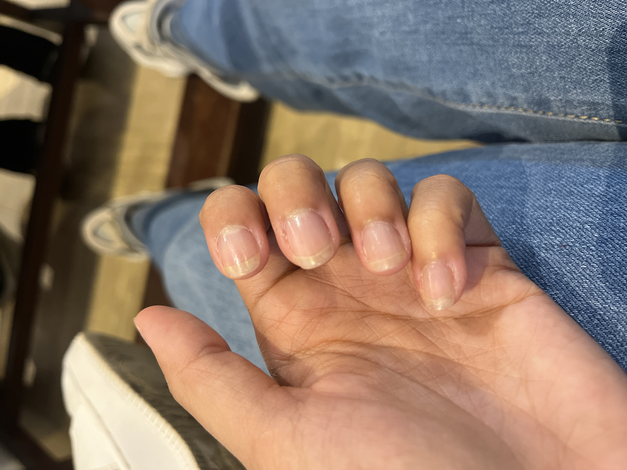 The image displays a close-up, high-angle view of an individual's right hand resting, palm facing upward, with fingers slightly curled. The skin of the hand is of medium brown tone, and clear dermatoglyphics are visible on the palm. All five fingernails are visible, appearing unpolished, with irregular lengths and some yellowish discoloration at the free edge. Minor periungual redness is observed around the cuticles of several fingers, notably the index and middle fingers. The individual is wearing blue denim jeans, visible on the lower right side of the frame. In the mid-ground, two additional feet, shod in light-colored sneakers and also wearing blue denim jeans, are visible. One white sneaker is partially visible on the upper left, adjacent to the thumb, likely belonging to the individual whose hand is in the foreground. The background is blurred, showing a warm-toned, possibly wooden, floor or steps, and darker, indistinct shapes suggesting an indoor environment. The image does not contain identifiable features or contextual information to confirm a specific geographical location, including the city of Santa Ana, Venezuela.