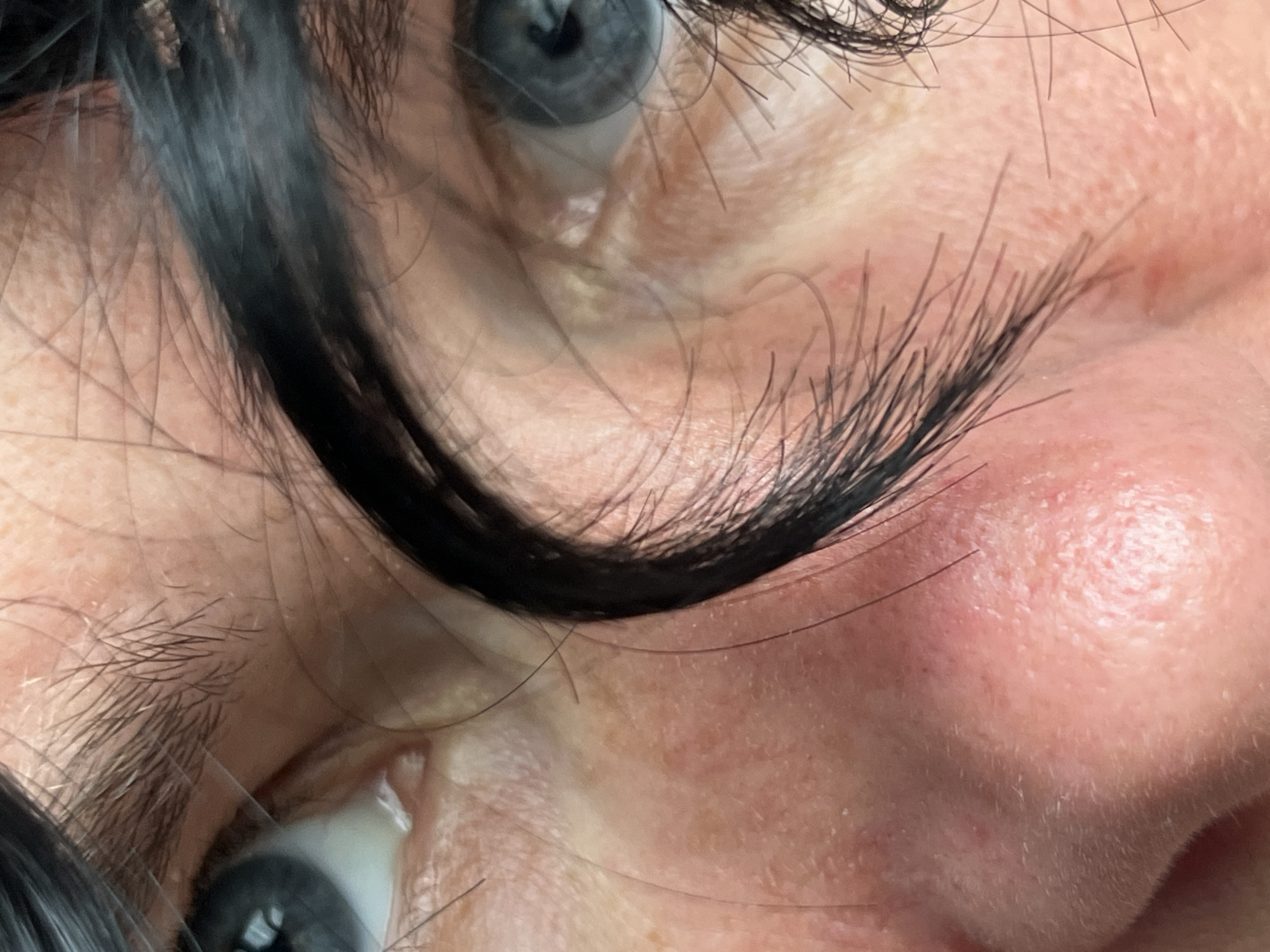 The image is a close-up, unposed shot of a person's face, focusing on the area around their eyes and nose. The subject has dark hair that partially obscures the view of their skin. The skin texture is visible, showing pores and a slight redness in some areas. The lighting suggests an indoor setting, and there are no obvious environmental cues to indicate time of day or weather. The overall tone of the image is neutral, with no strong emotions conveyed by the visible portion of the face. There is no visible text in the image. The provided location context, "ღრმაღელის თემი, Georgia," indicates the geographical origin or setting, but this information is not visually represented within the image itself.