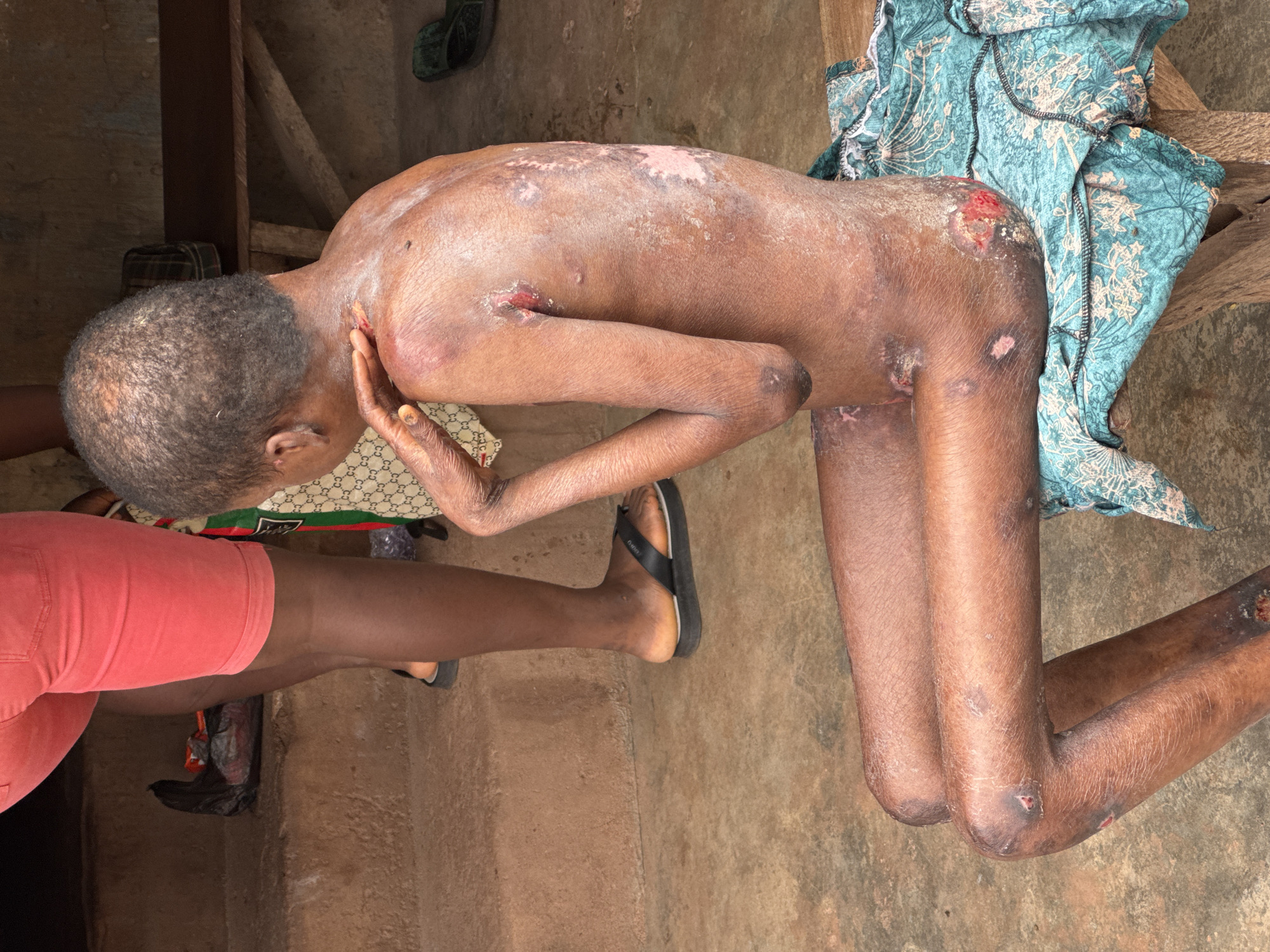 The image, captured in an outdoor setting likely within Enugu, Nigeria, shows a person sitting on a wooden bench with a teal and white patterned cloth. The individual, seen from the rear and side, appears to be experiencing a severe skin condition, with widespread lesions, scabs, and areas of apparent inflammation across their back, arms, and legs. The skin is dry and flaky in many areas, with some lesions appearing open and raw. The person's hair is short and appears thinning. Nearby, another person's legs are visible, wearing bright coral-colored shorts and black flip-flops. A black plastic bag and some items are on a raised step behind the seated individual. The ground is a concrete or dirt surface. The overall environment suggests a modest, possibly rural or semi-urban, setting.
