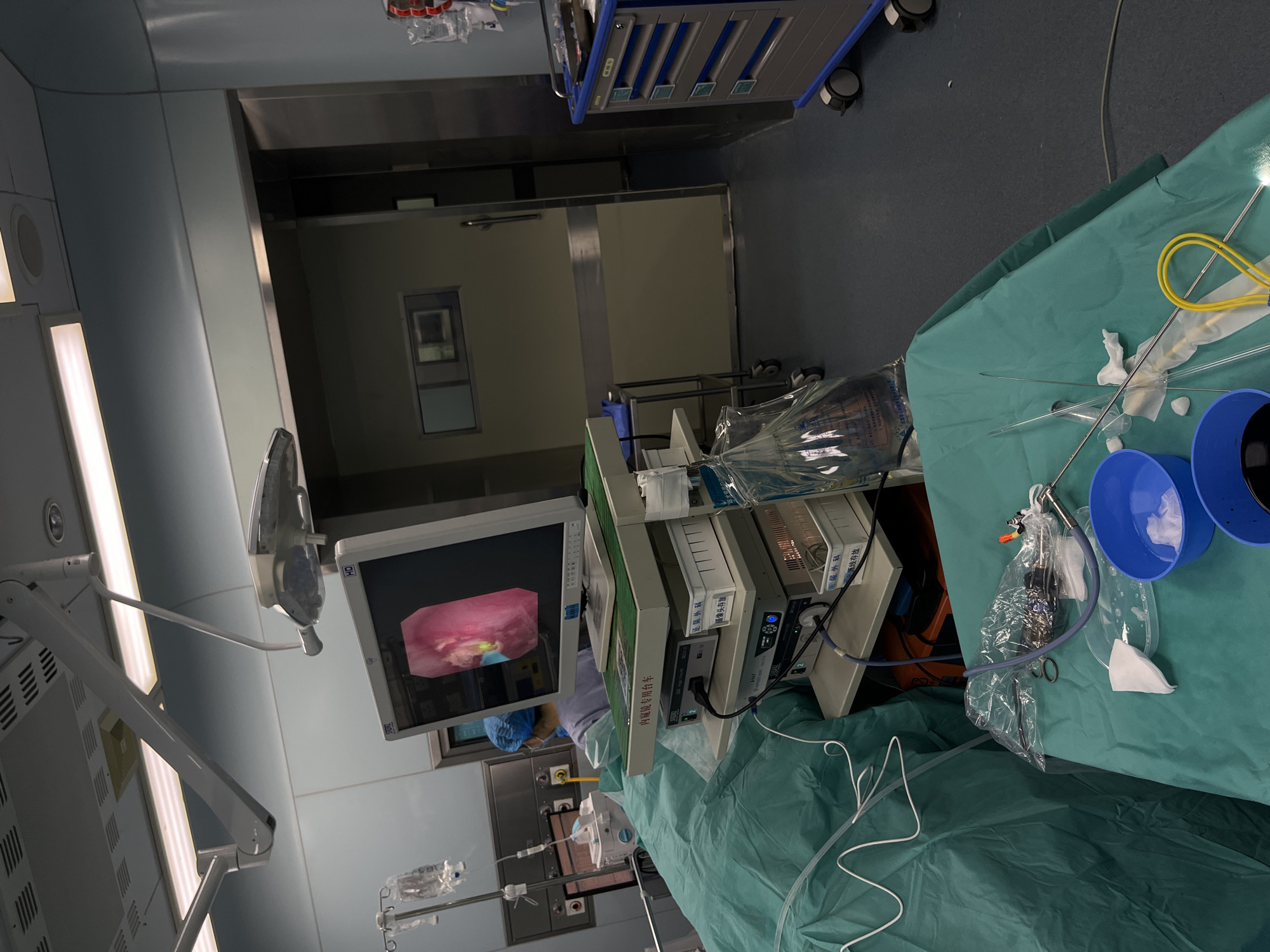 The image depicts an operating room during a medical procedure, possibly in the Yuzhong District of China. The scene is dominated by a monitor displaying an internal image, likely from an endoscope, and surgical equipment draped over a table covered in green sterile fabric. Two blue buckets are visible on the table, likely for collecting fluids. The room features standard medical fixtures like surgical lights, an IV stand, and a rolling cart. An individual in a surgical cap is visible near the monitor, implying a surgical team is present. Text on the equipment, including "内窥镜专用台车" (endoscope trolley) and "泌尿外科" (urology), indicates the medical specialty involved.