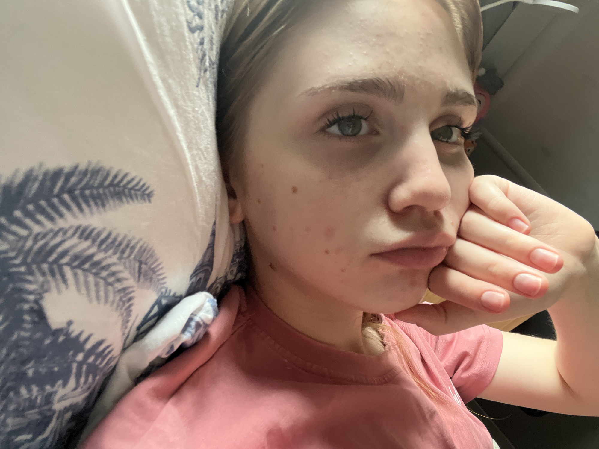 A young female, appearing to be in her late teens or early twenties, rests her head on a pillow with a blue palm leaf pattern. She is looking slightly to the right, with her right hand supporting her chin. Her face shows signs of acne, with several red blemishes visible on her cheeks and forehead. She is wearing a pink t-shirt. The background is dark and out of focus, suggesting an indoor setting. There is no indication of the city of Ashkadar, Russia, or any specific urban environment.