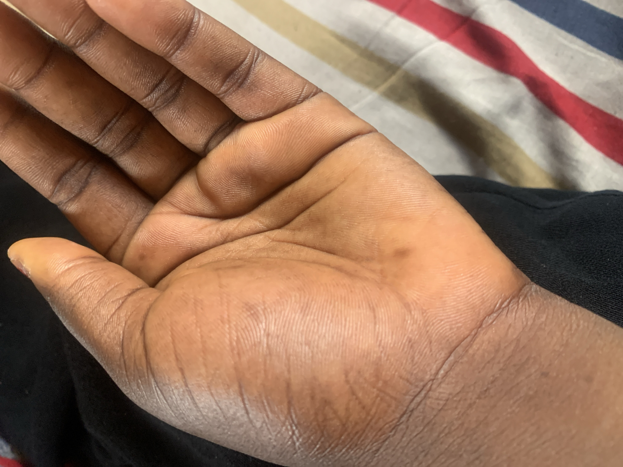 The image shows a close-up view of the palm of a person's hand. The skin is dark-toned with visible lines and creases. There are a few small, darker spots on the palm. The hand is positioned over a dark fabric, possibly clothing, and a striped surface with red, white, yellow, and blue stripes. The lighting suggests an indoor setting. There is no information in the image that can be used to determine its location in Jauro Yinu, Nigeria.
