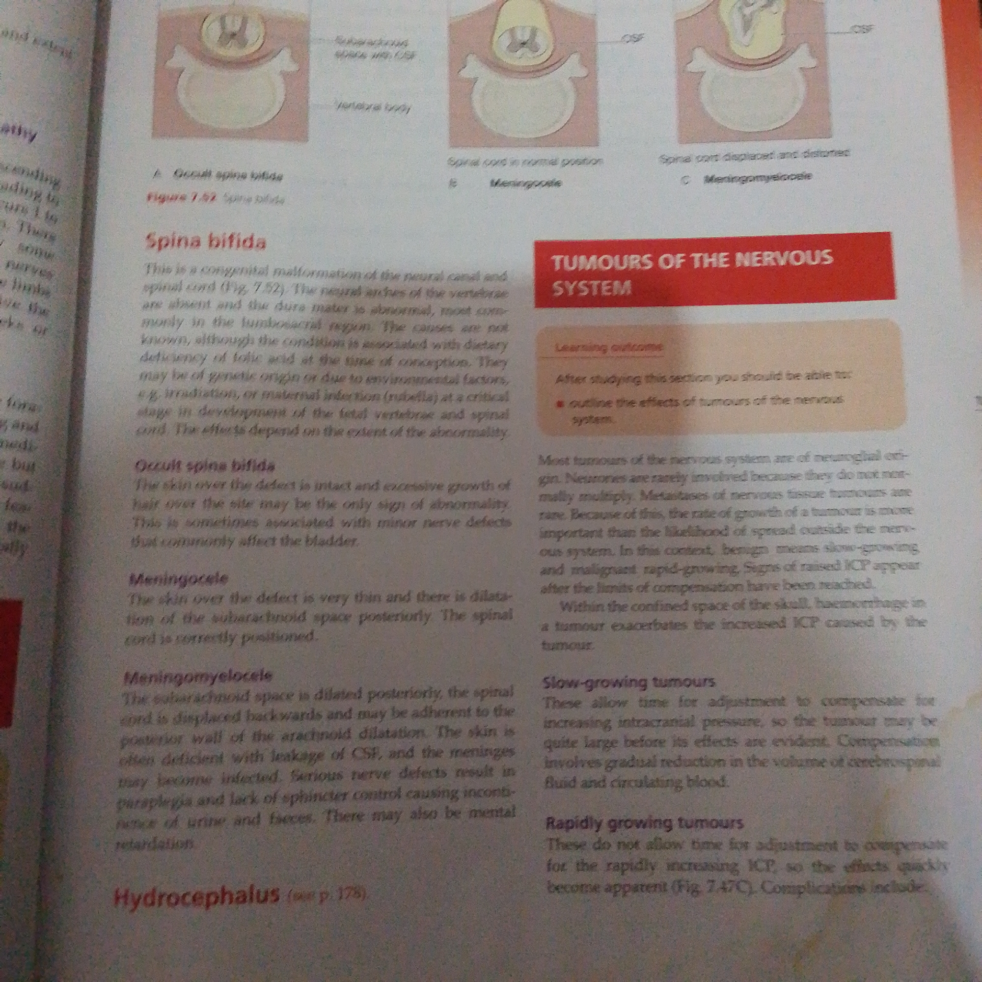 The image shows a page from a medical textbook. The page contains text and illustrations related to spinal deformities and tumors of the nervous system. Specifically, it discusses conditions like Spina bifida, Meningocele, and Meningomyelocele, along with information on tumors of the nervous system, differentiating between slow-growing and rapidly growing types. There are no elements in the image that suggest a location in Jalingo, Nigeria, or any forensic details.