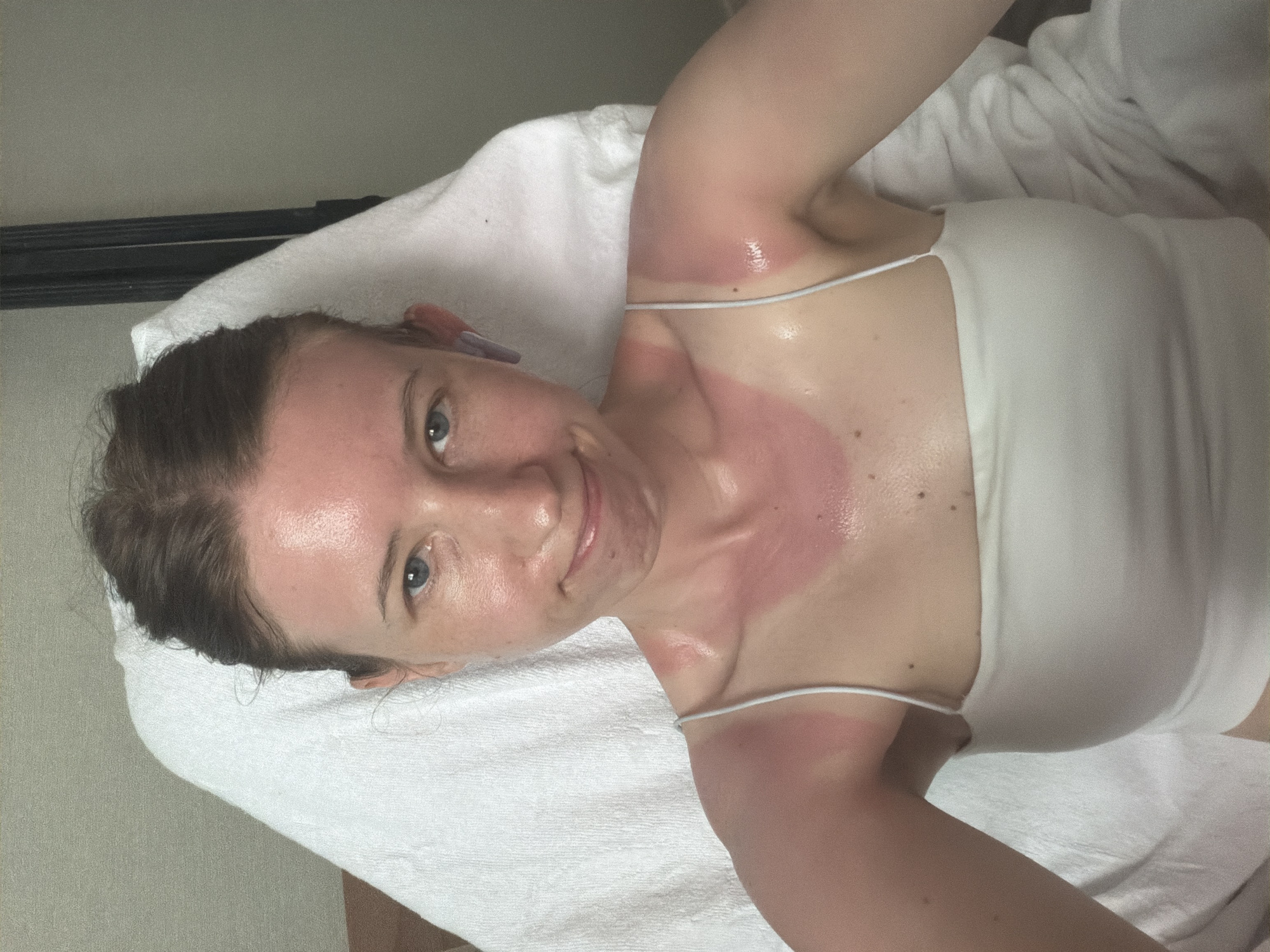A young woman with fair skin and auburn hair pulled back in a bun is sitting on a white towel. She is wearing a white tank top with thin spaghetti straps. Her shoulders, neck, and upper chest are visibly sunburned, with red skin and a sheen of sweat. She is looking at the camera with a slight grimace and a faint smile. The background appears to be an indoor setting, possibly a hotel room, with a wall and part of a dark frame visible. There are no specific landmarks or elements in the image that would indicate the city of Dongducheon-si, South Korea.