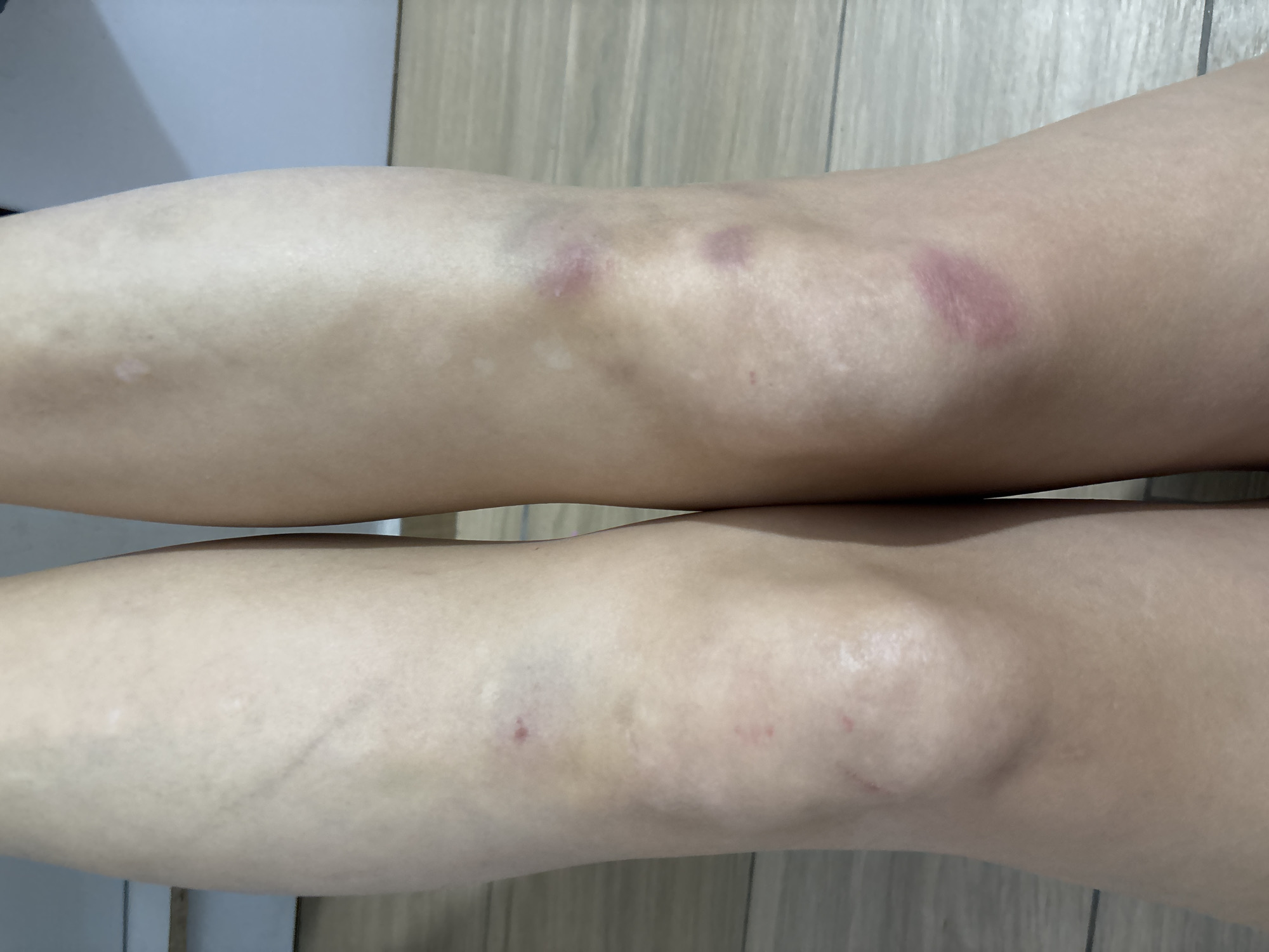 A pair of human legs, specifically the lower thighs and knees, are depicted from a frontal, slightly elevated perspective. The skin exhibits a light to medium tone. The left leg presents several small, reddish abrasions or scabs concentrated around and below the patella, alongside faint areas of purplish discoloration. The right leg displays three prominent, reddish-purple, oval to circular lesions or contusions: two are located superior to the patella, and one is directly on it. Minor skin texture variations are observable. The legs rest on a light-colored, wood-grain floor, likely laminate or hardwood planks, which features horizontal lines. The background consists of a light-colored, possibly white, vertical surface to the left and a light blue-gray wall to the right. The scene is illuminated evenly, indicating an indoor environment within the city of Izhevsk, Russia.