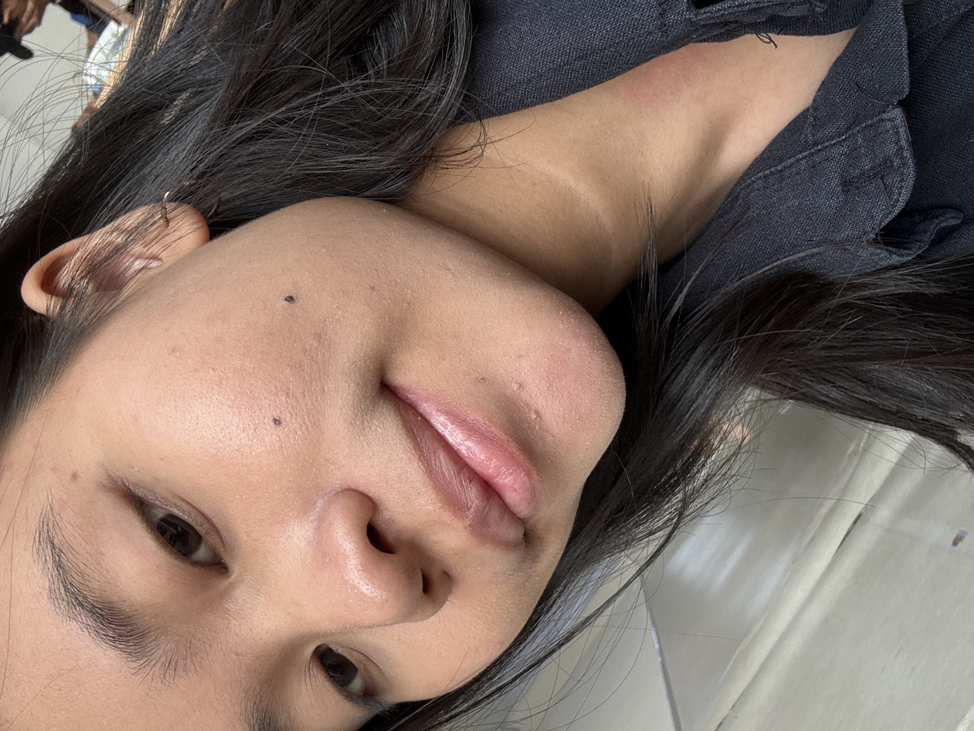 The image is a close-up, high-angle shot of a young Asian female's face, focusing on her left cheek, nose, mouth, and neck. She has dark hair, some of which is visible framing her face and falling over her shoulder. She is wearing a dark collared shirt. There are several small blemishes on her face, particularly around her chin and cheek. One mole is visible on her cheekbone, and another on her jawline. Her lips appear to be slightly dry and chapped, with a subtle pink hue. The background is blurred, but appears to be an indoor setting with some light-colored walls and possibly furniture. No specific location in East Jakarta, Indonesia can be identified from the image.
