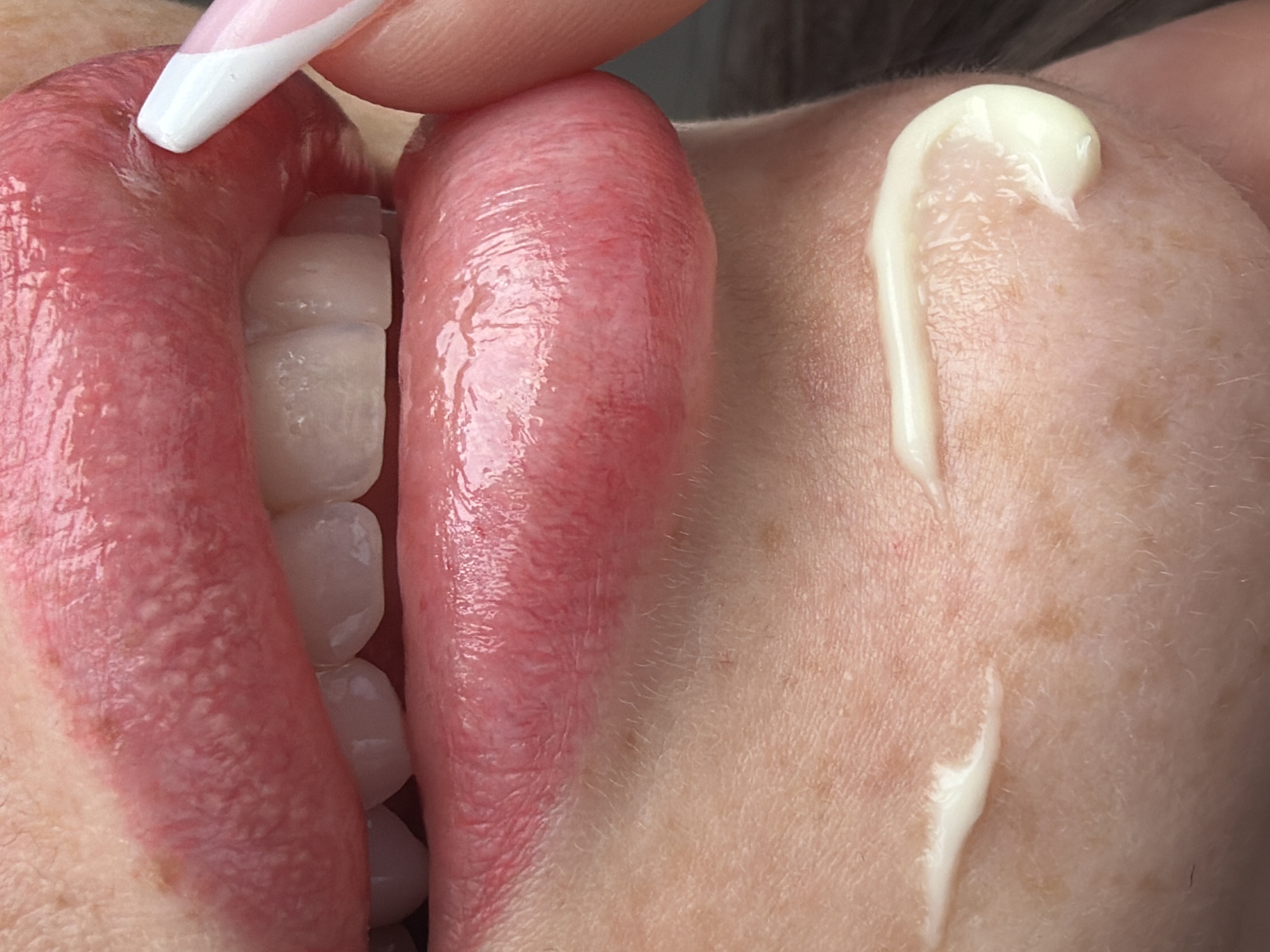 This is an extremely close-up shot of a person's mouth and adjacent skin. A finger, adorned with a white-tipped, pink-based French manicure, is visible pressing against or holding open the lips on the left side of the frame. Inside the mouth, a set of uniformly white, well-aligned teeth are visible, suggesting dental work such as veneers or crowns. The inner lips and gum tissue are a vibrant reddish-pink and appear moist.
On the skin to the right of the mouth, a streak of a light-colored, creamy substance, possibly an ointment or cosmetic product, is present. The skin itself has fine pores, some visible fine hairs, and scattered freckles or small moles. The image captures a moment that could be associated with a dental examination, a cosmetic procedure, or the application of a topical treatment. There is no discernible text, specific location cues, or clear indication of the time of day or emotional state. The focus is entirely on the textural and color details of the human mouth and surrounding skin.