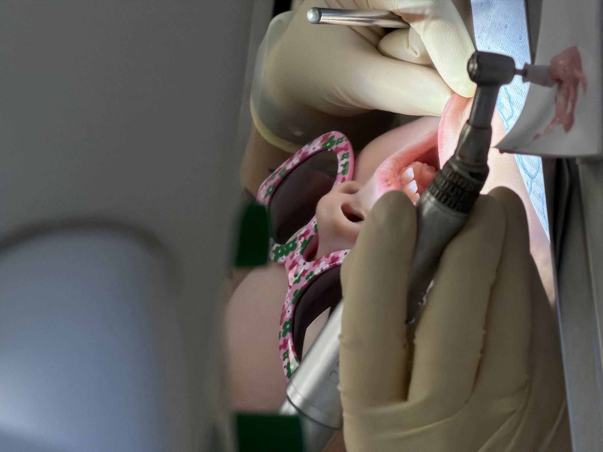 A close-up shot depicts a dental procedure in progress. A person wearing floral-patterned sunglasses is positioned in a dental chair. Two gloved hands manipulate dental tools inside the patient's mouth, including a drill and a dental pick. White cotton rolls are visible. The patient's pink inner cheek and teeth are in focus. Part of the dental equipment appears blurry in the foreground. The background is a mix of gray and blue tones, potentially indicating walls or equipment within a dental office. No specific location in Kamyshin, Russia is evident from the image.