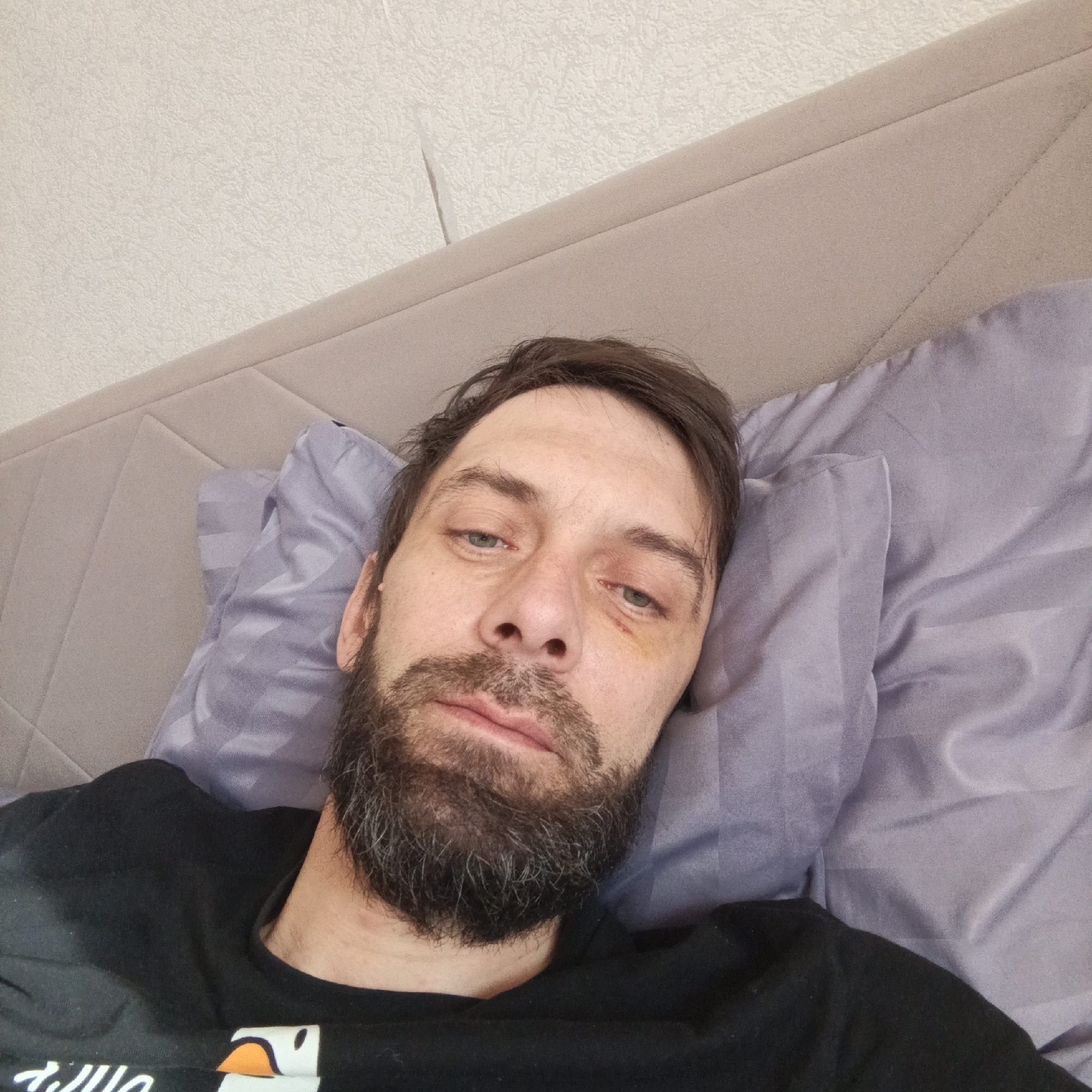 A close-up photograph shows a man lying in bed. He has dark hair, a beard, and visible bruising around his right eye. He is resting on a lavender-colored pillow and wearing a black t-shirt. The background includes a padded headboard and a textured, light-colored wall. There is no information to identify this location as being in Марковский, Russia.